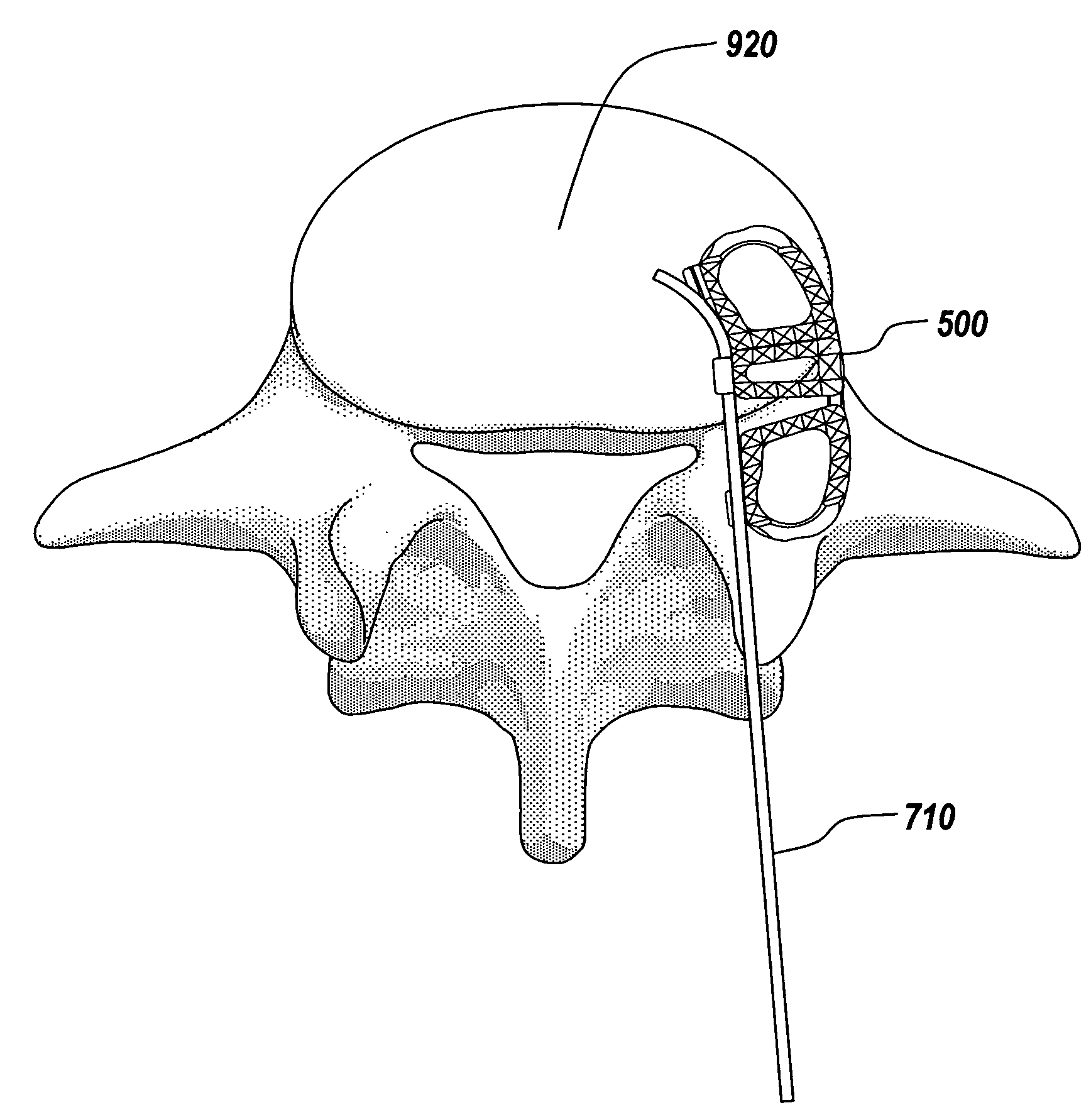 Spinal fusion implant