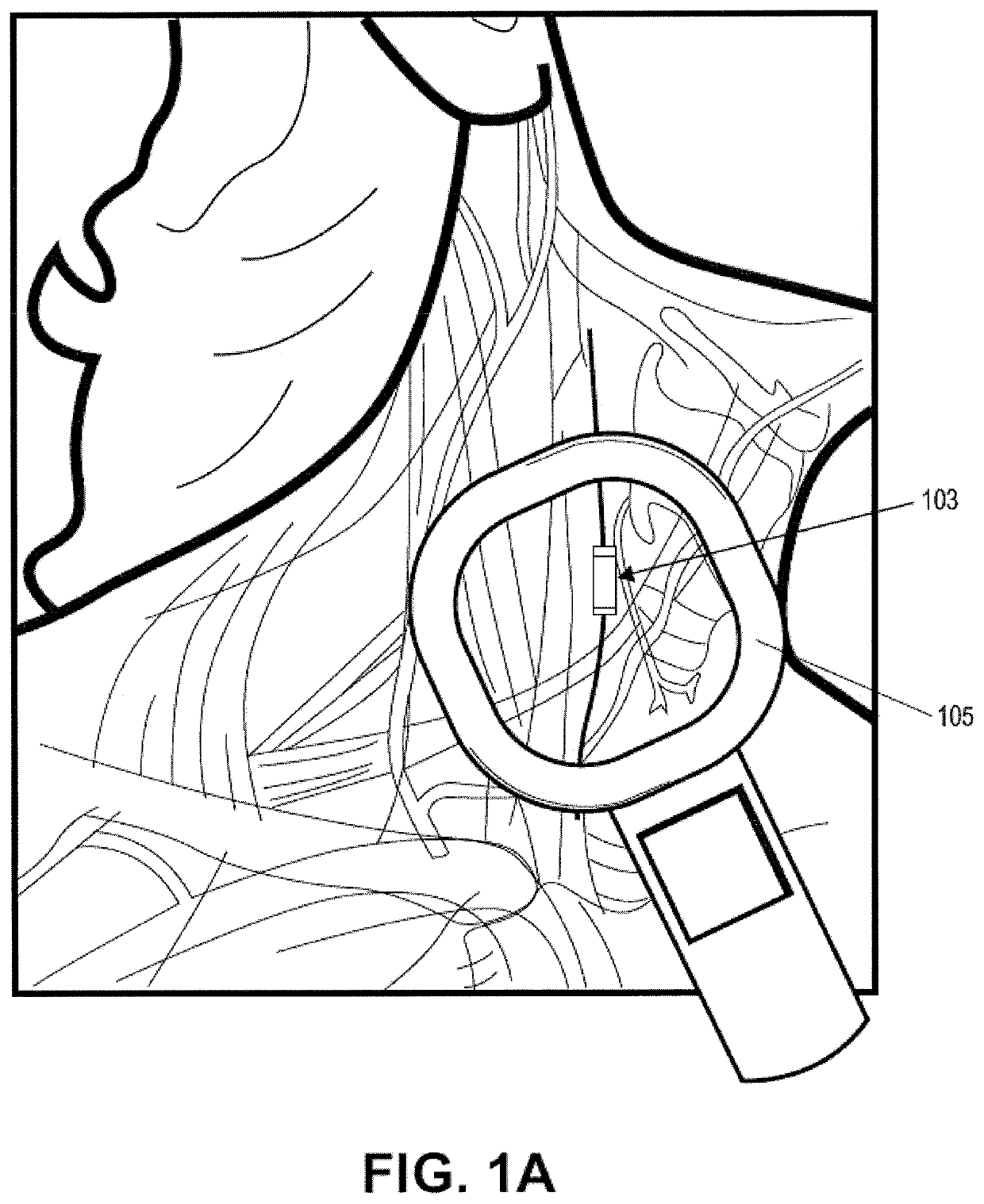 Closed-loop vagus nerve stimulation