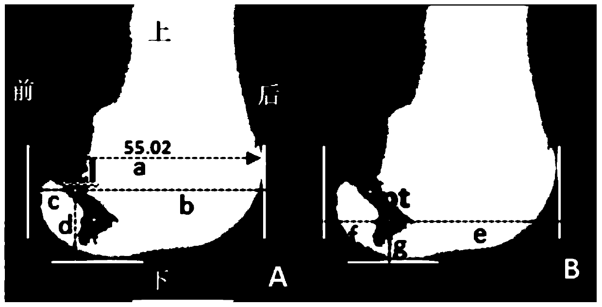 Morphological recognition and visualization method for tendon-bone joint part of knee joint posterior-lateral complex