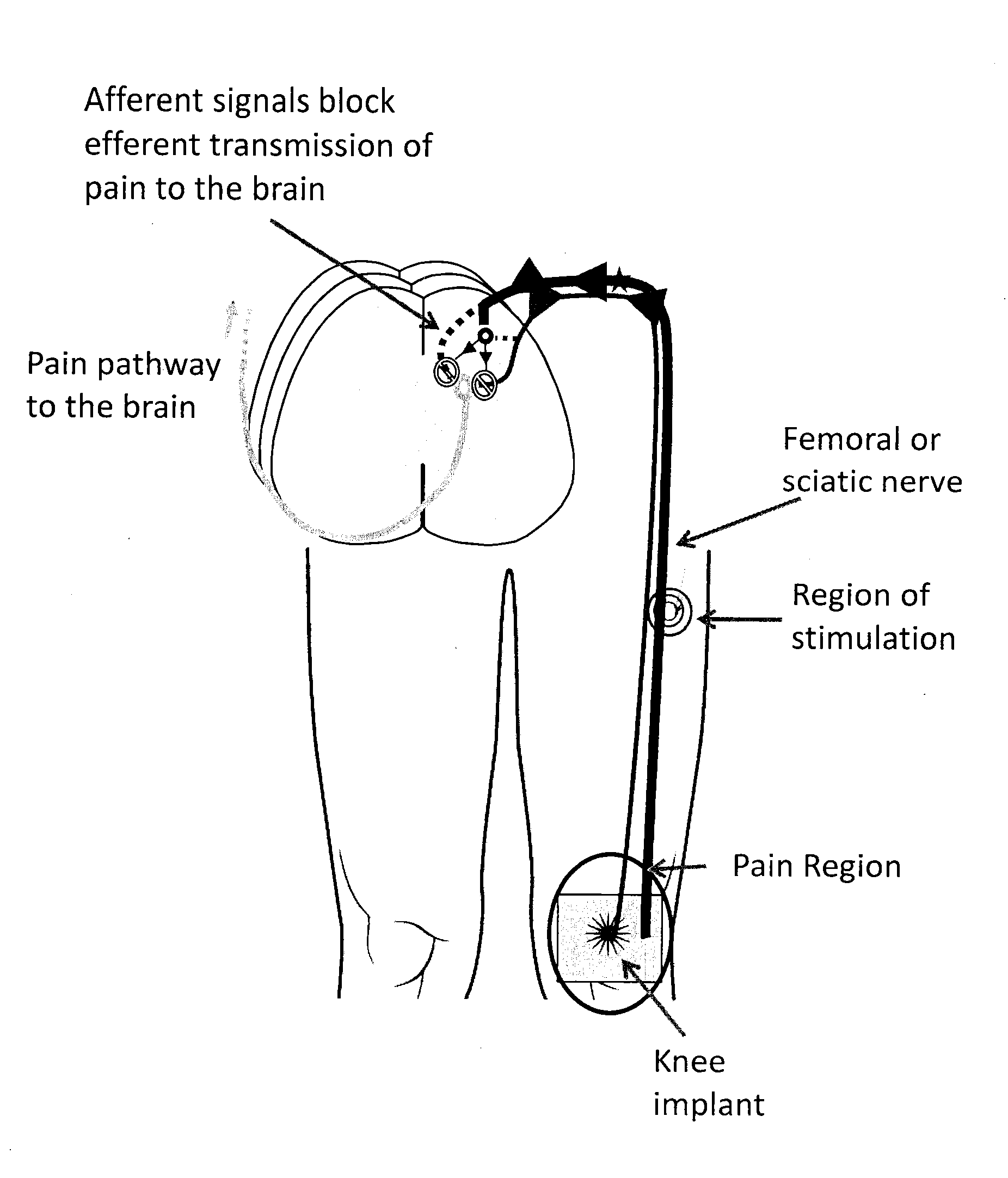 System and method for treatment of pain related to limb joint replacement surgery