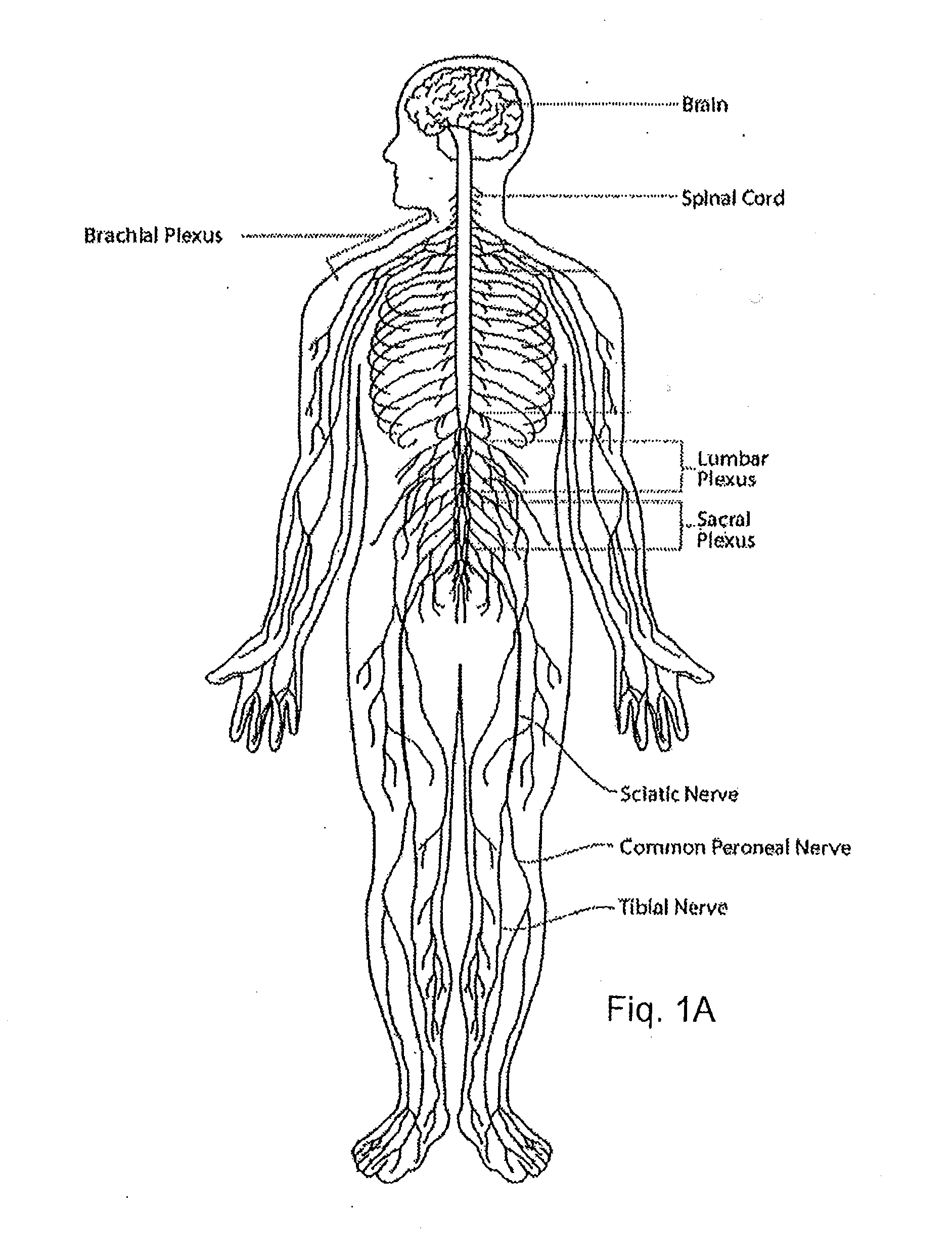 System and method for treatment of pain related to limb joint replacement surgery