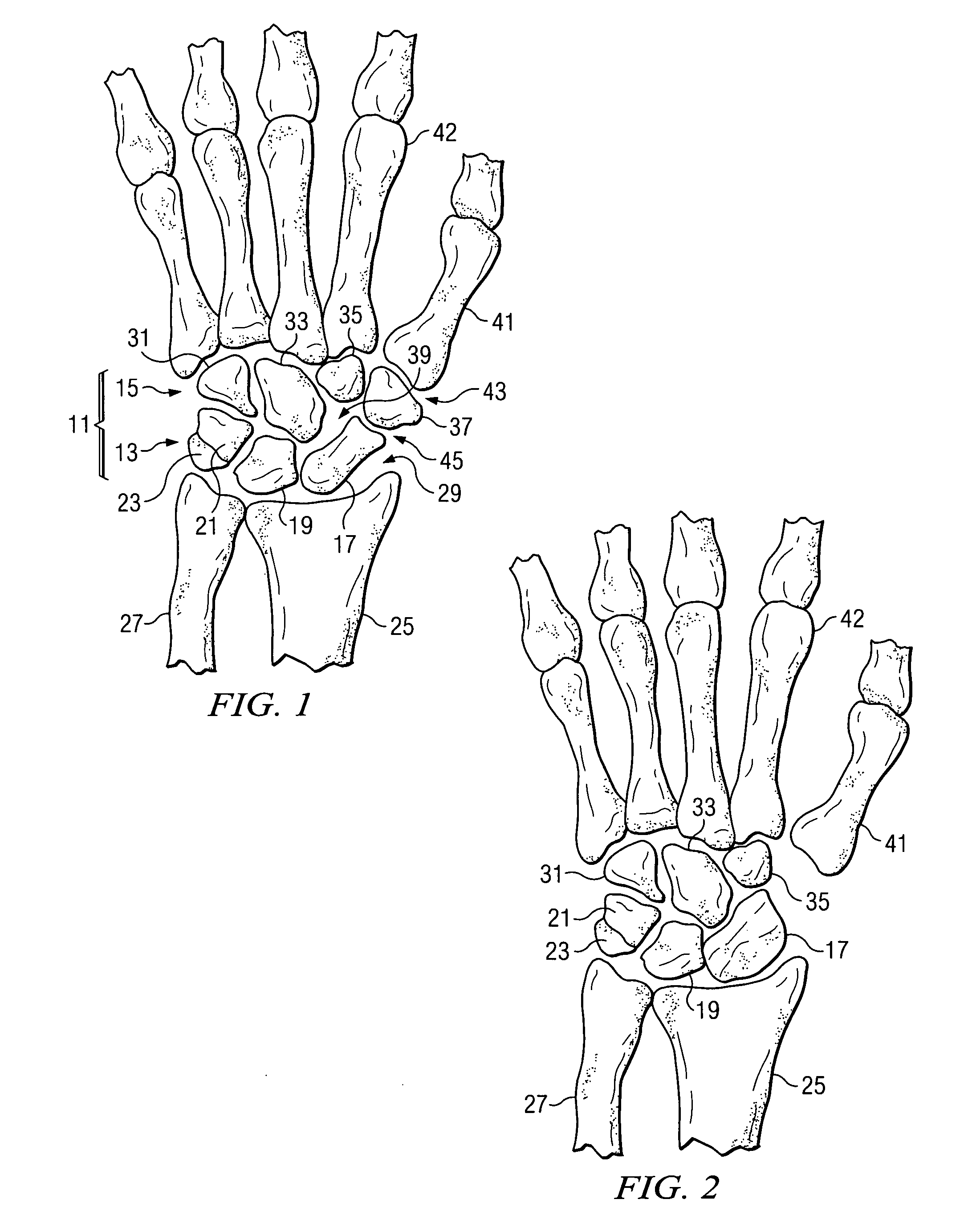 Trapezium prosthesis and method