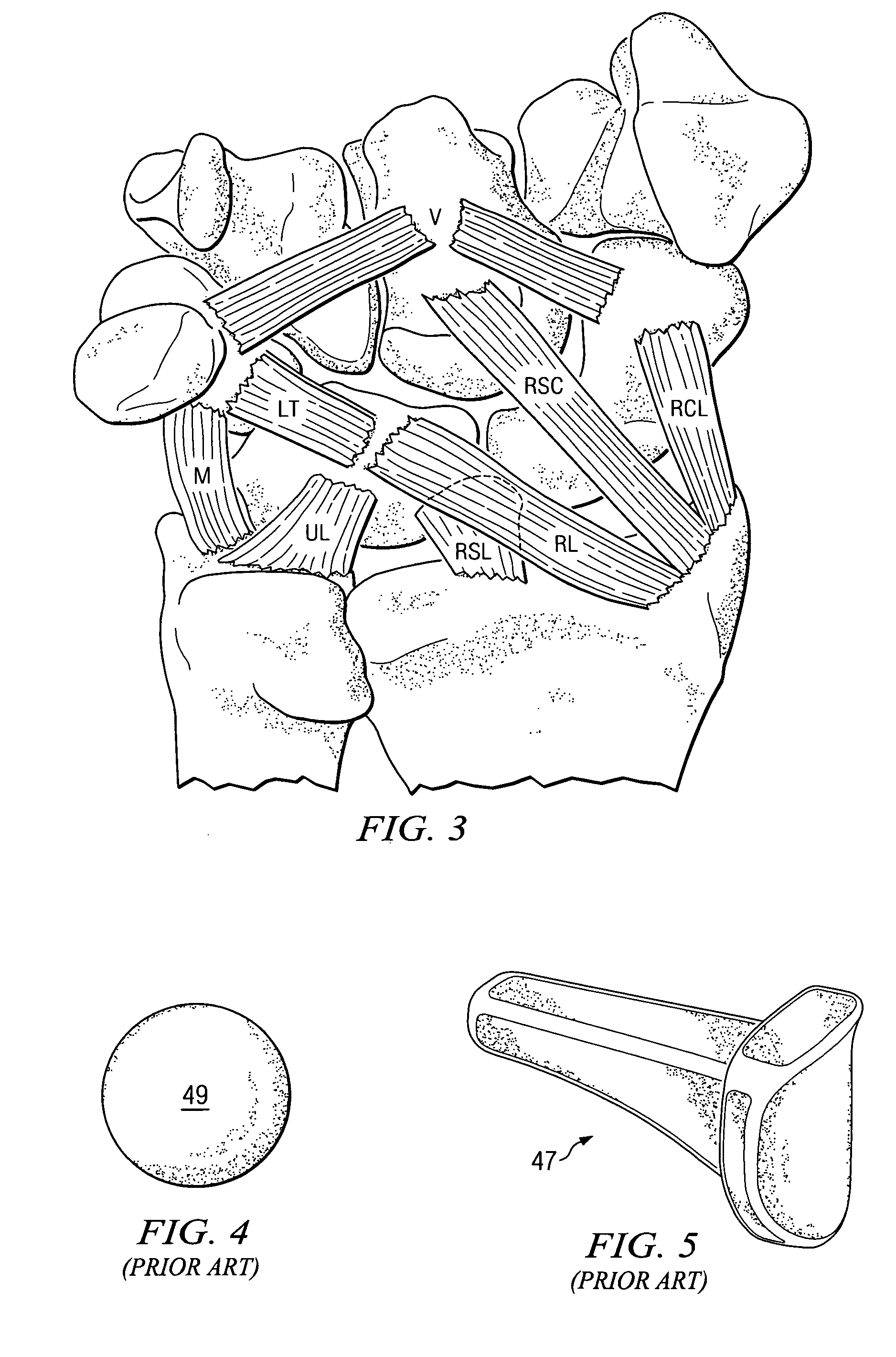 Trapezium prosthesis and method