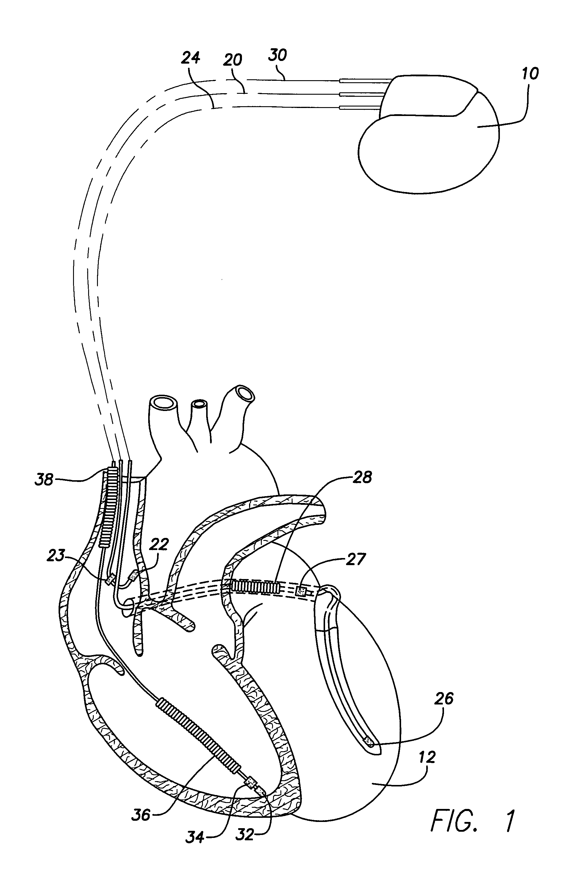 System and method for providing preventive overdrive pacing and antitachycardia pacing using an implantable cardiac stimulation device