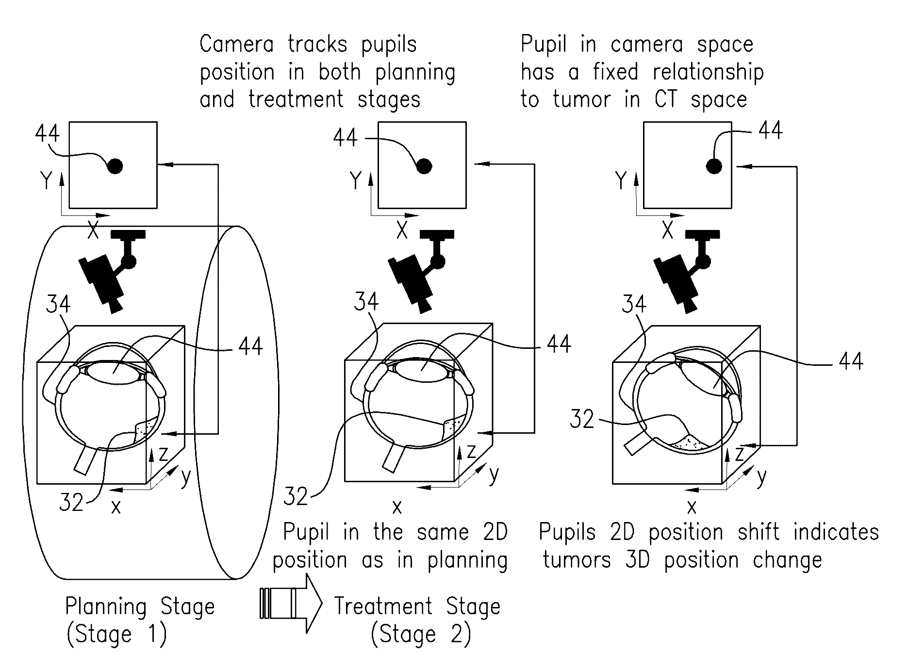 Radiation therapy device for ocular melanoma