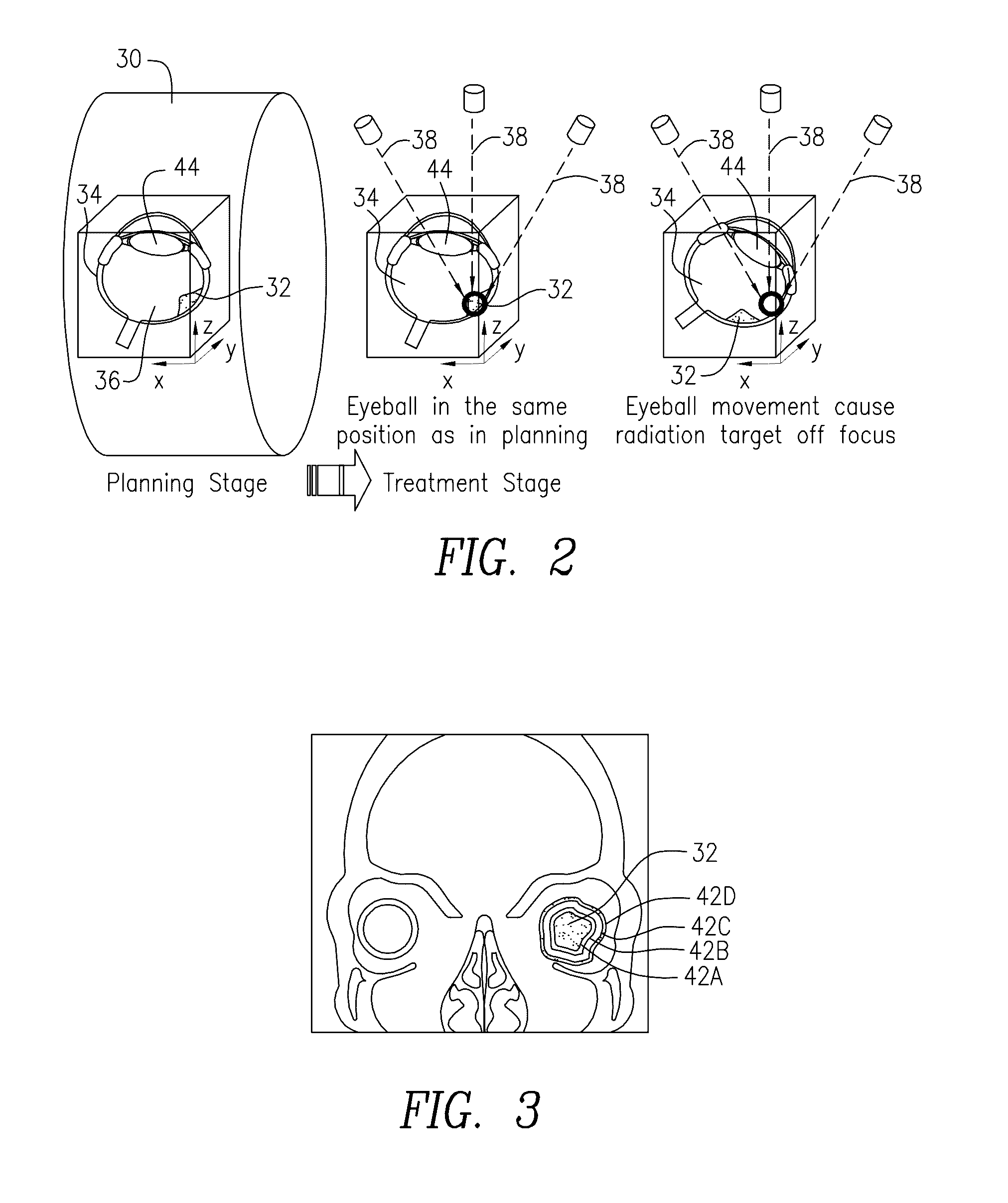 Radiation therapy device for ocular melanoma