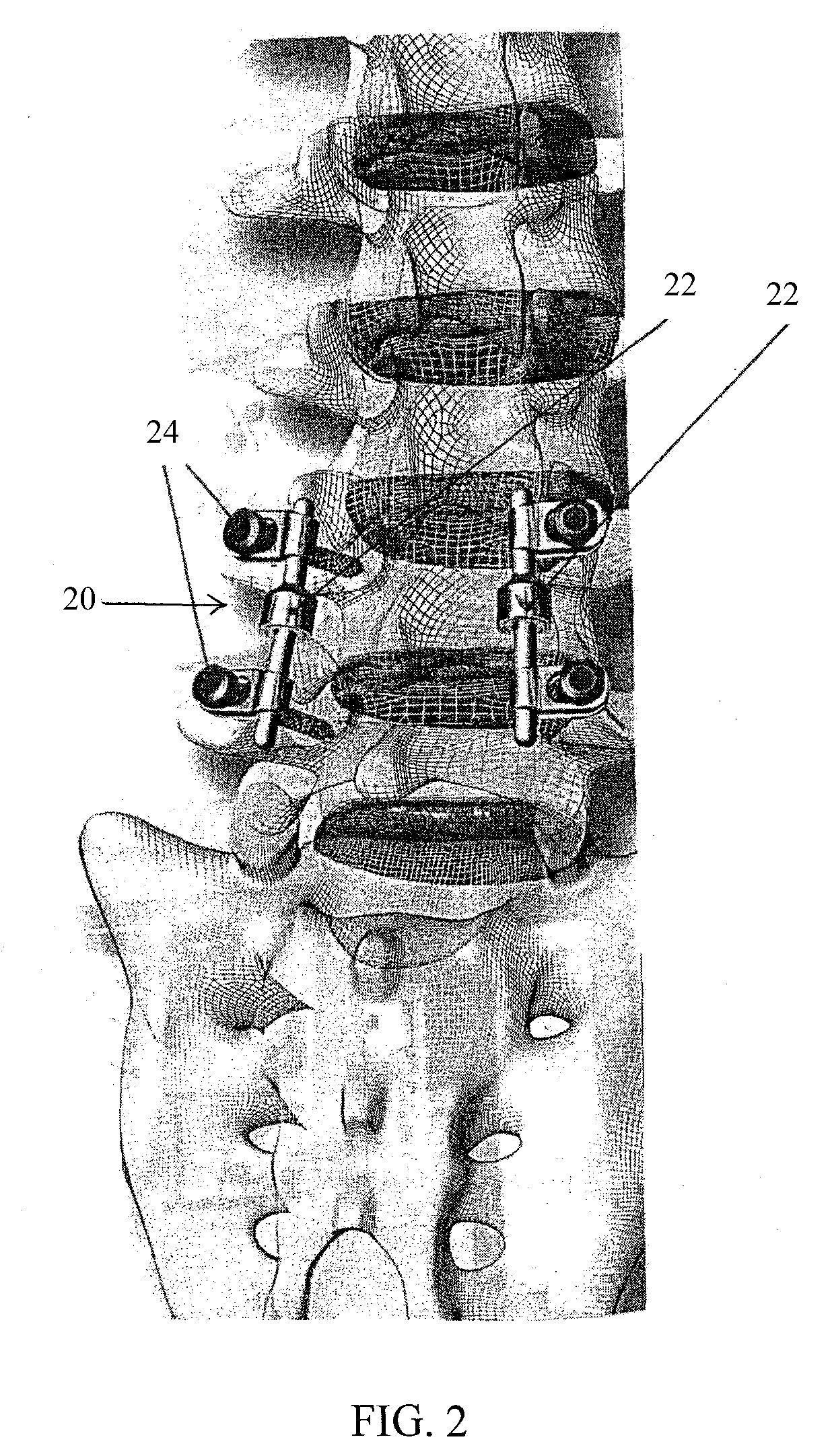 Spinal implant having a post-operative adjustable dimension