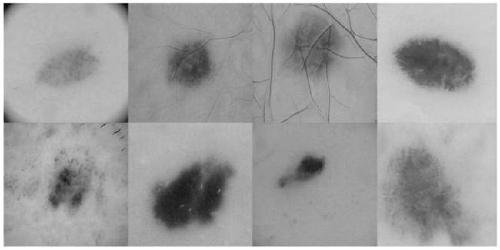 Dermatoscope image recognition method based on StyleGANs and decision fusion