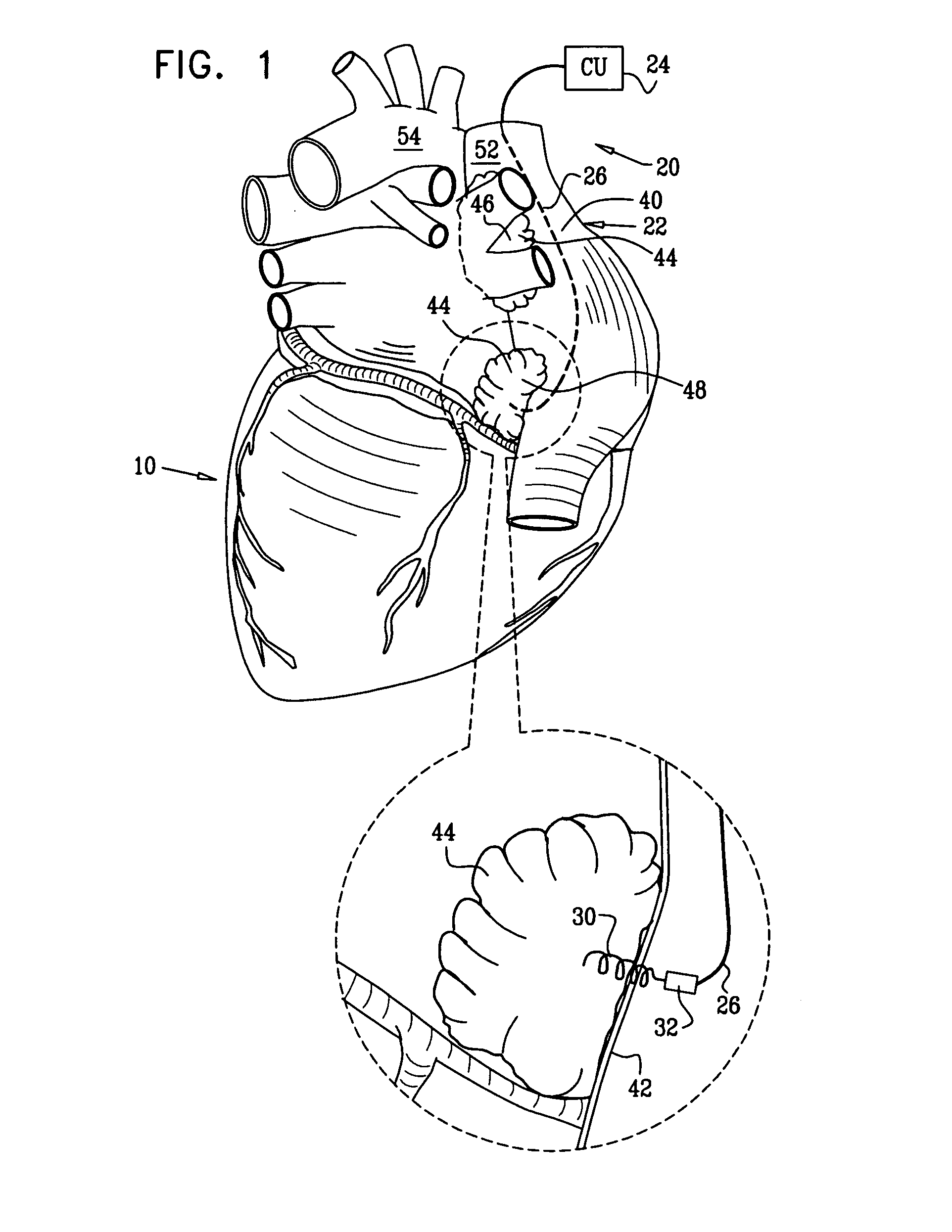 Intra-Atrial parasympathetic stimulation