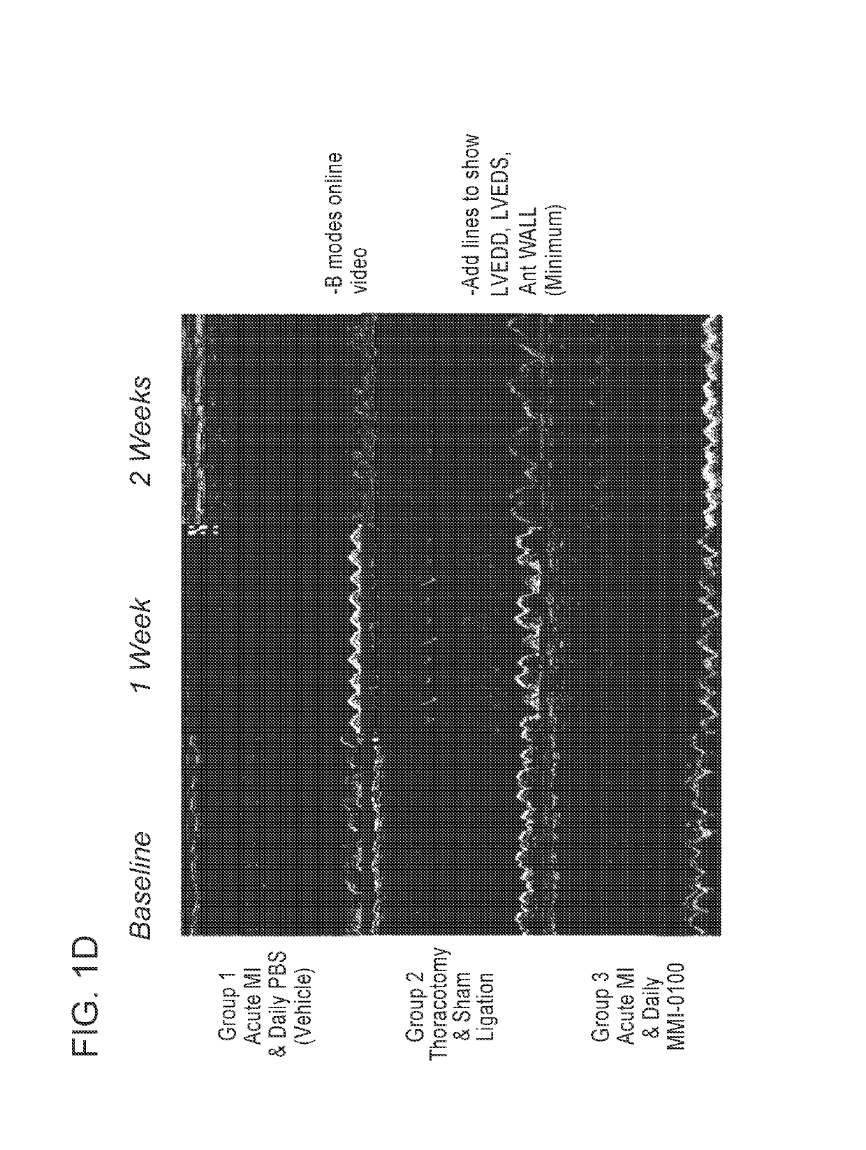 Inhibition of cardiac fibrosis in myocardial infarction