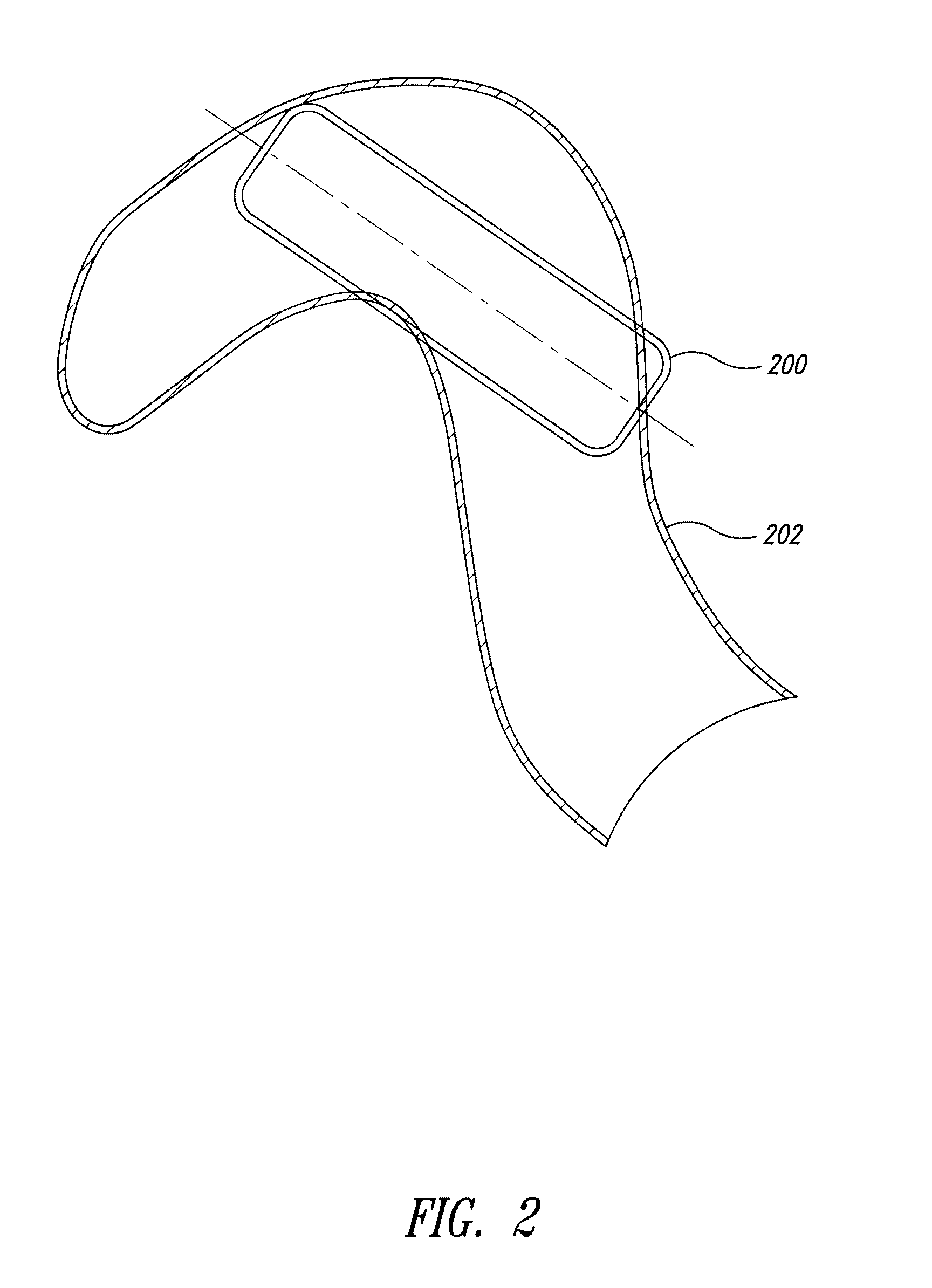 In vivo inflatable structures, for example to expand stents