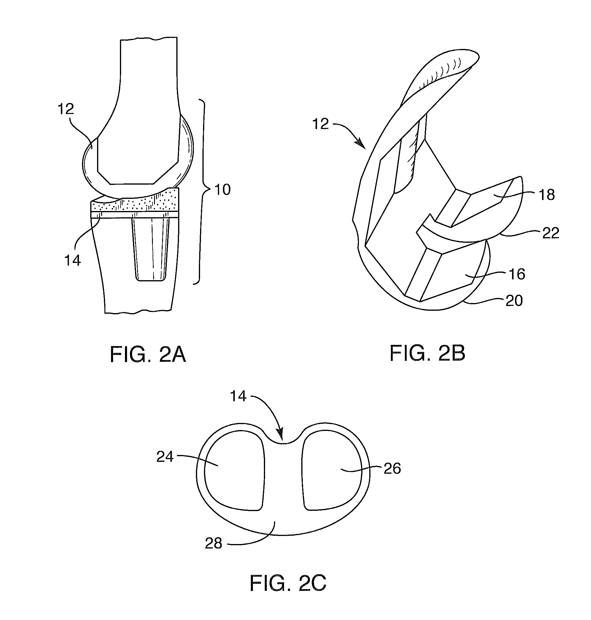 Systems and methods for providing a femoral component with a modified posterior condyle