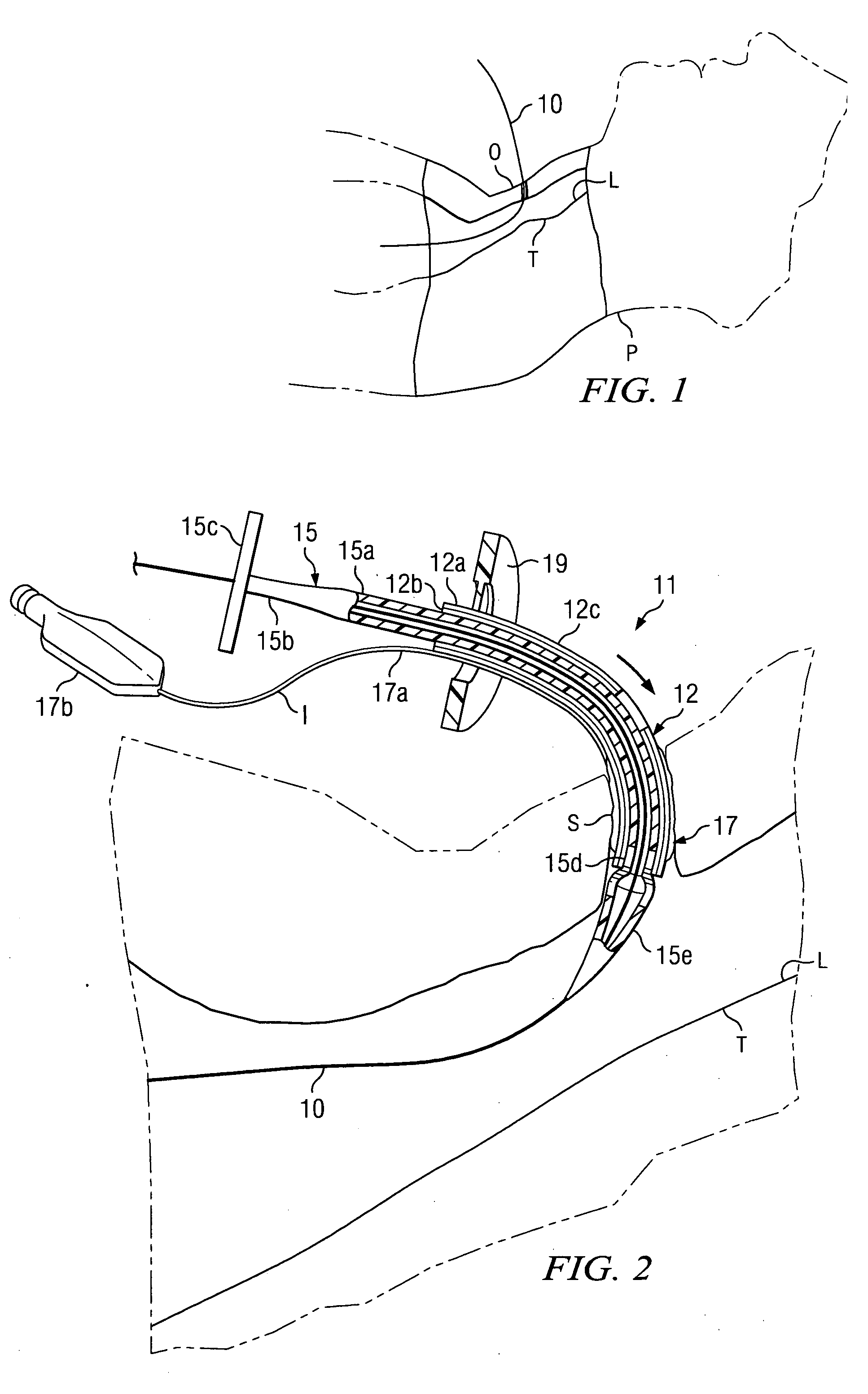 Tracheostomy system