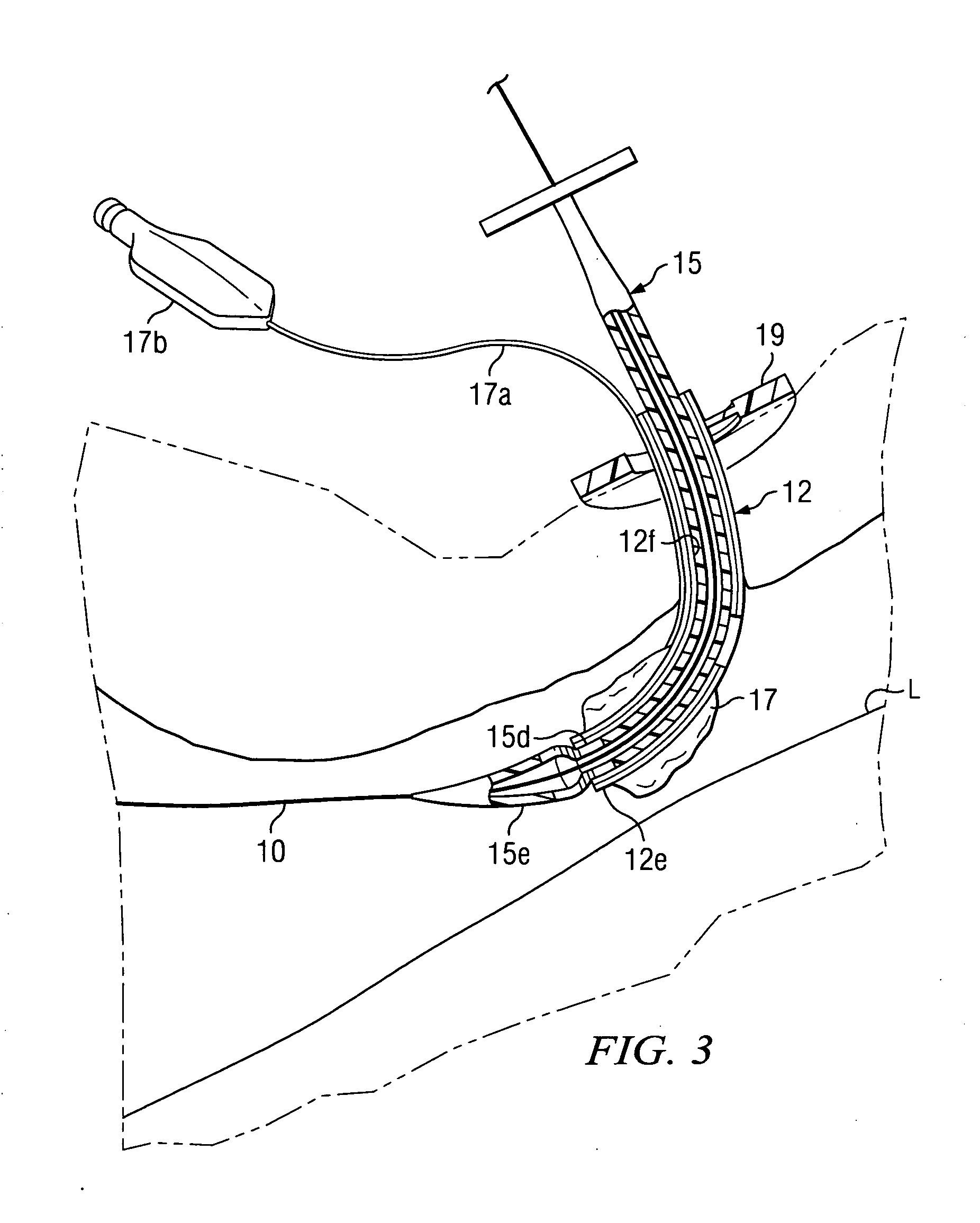 Tracheostomy system