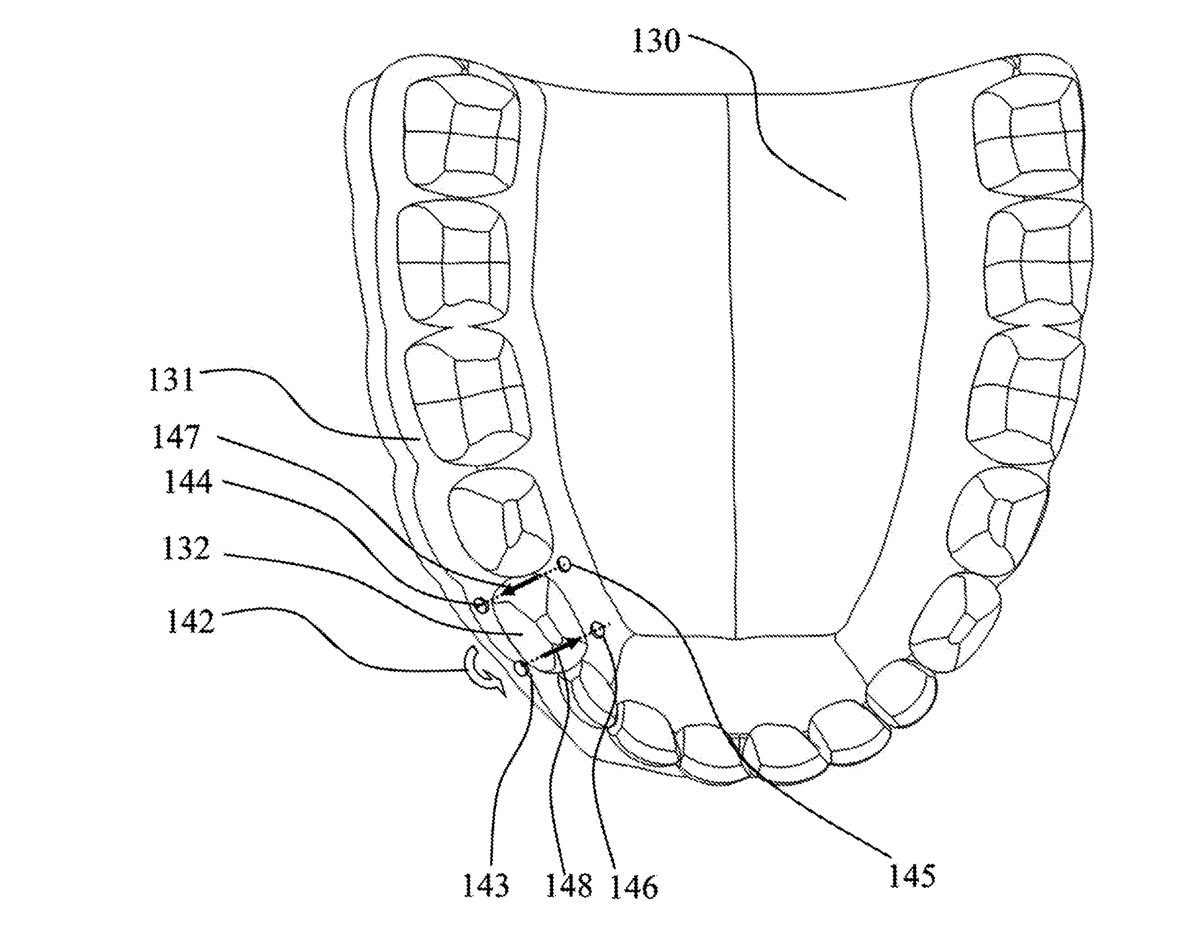 Method to enhance orthodontic tooth movement