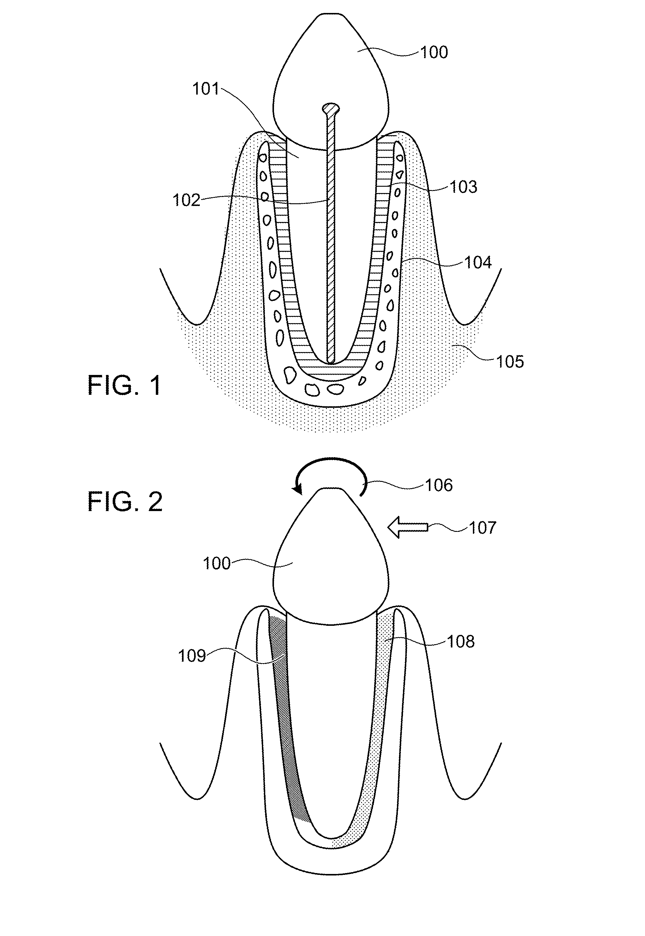 Method to enhance orthodontic tooth movement