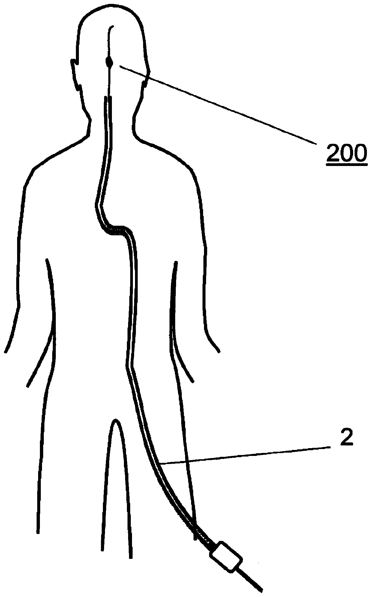 Method and apparatus for managing acute ischemic event