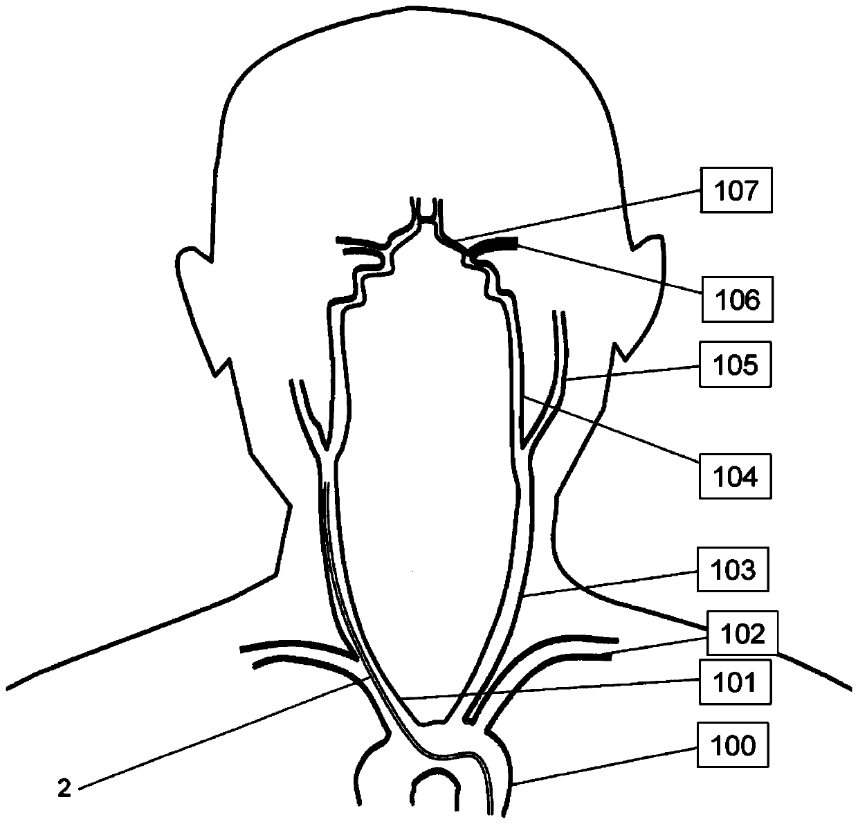 Method and apparatus for managing acute ischemic event