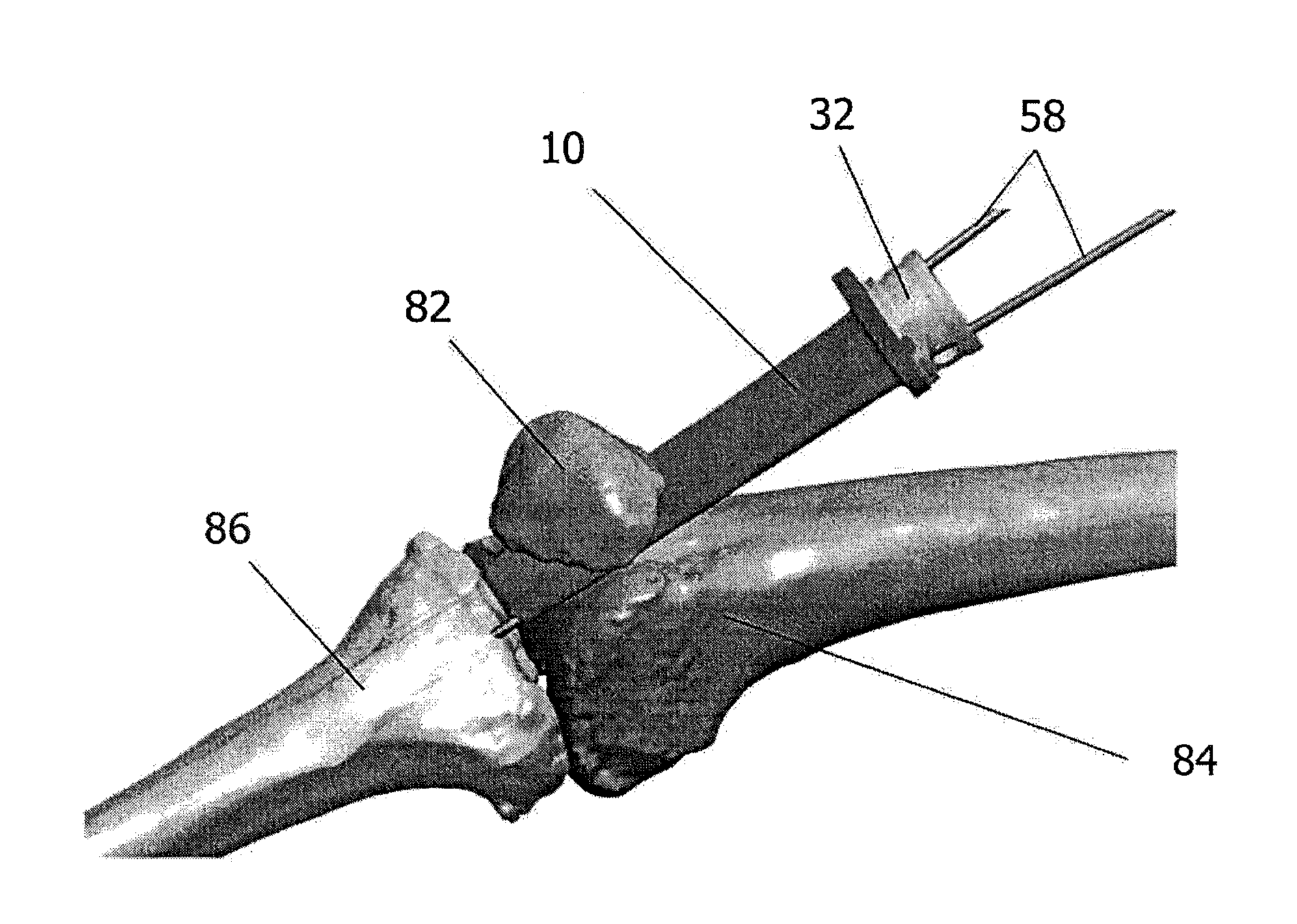 Guide sleeve for suprapatellar surgery