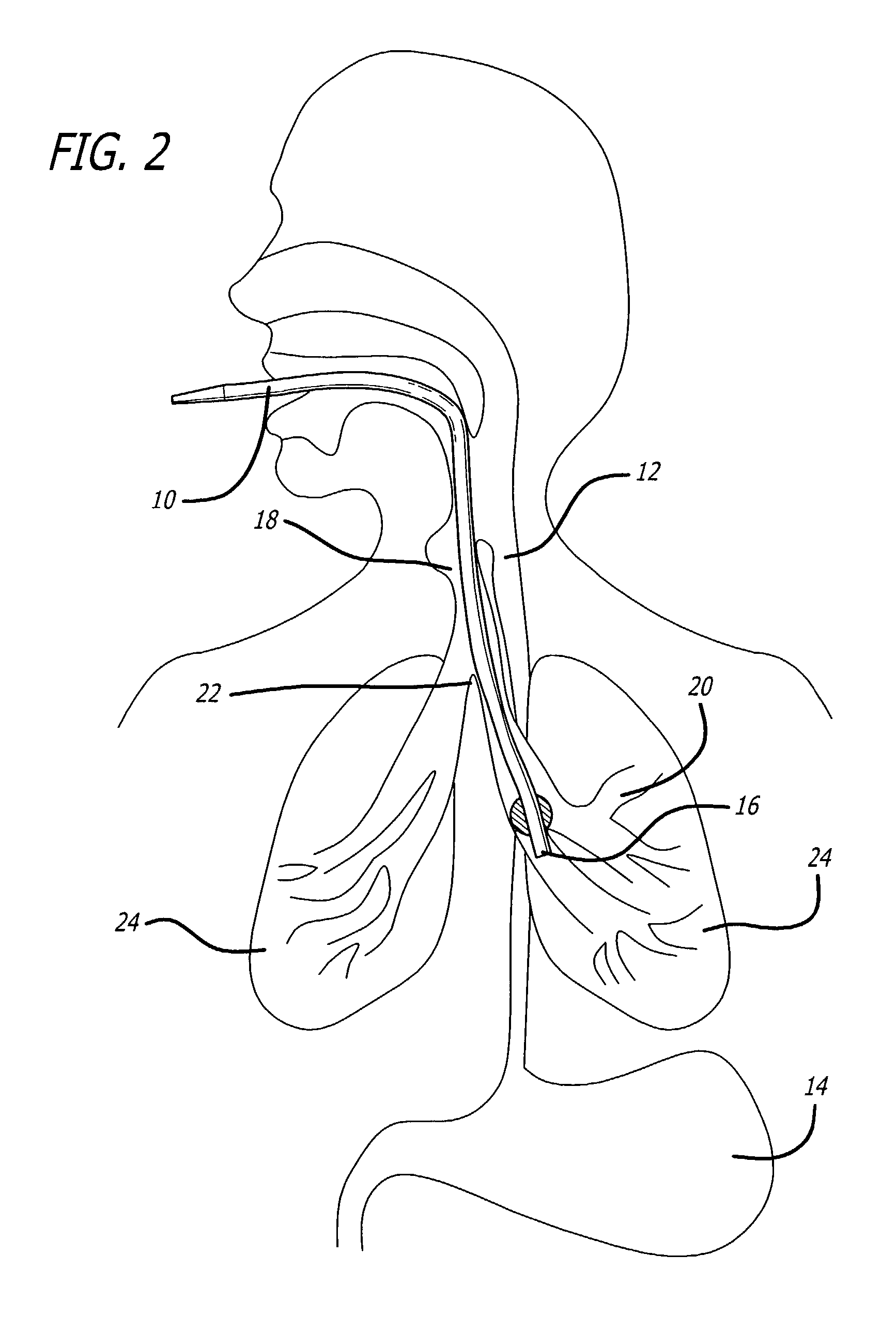 Determining endotracheal tube placement using acoustic reflectometry