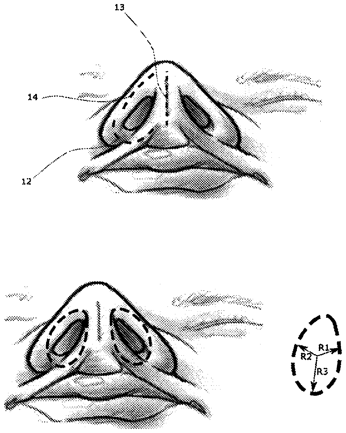 Nanofiber based nasal filter and a process of preparation thereof