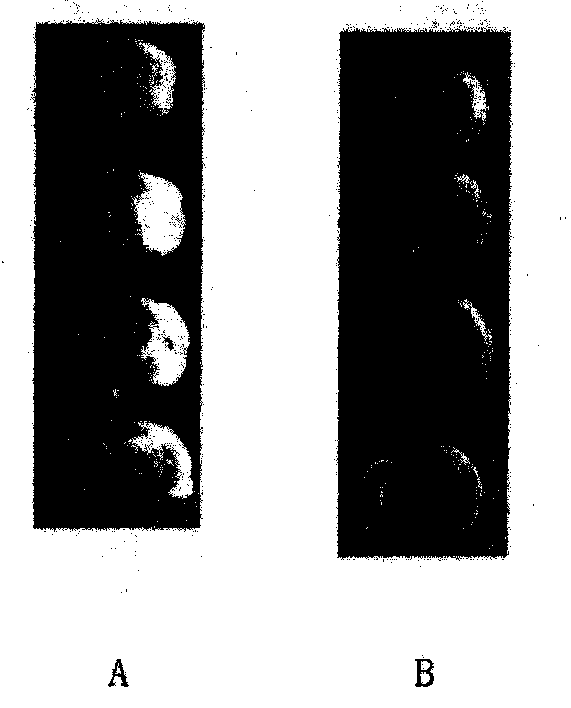 Bilobalide with aquaporin regulating effect and new use of derivative thereof in treating encephaledema