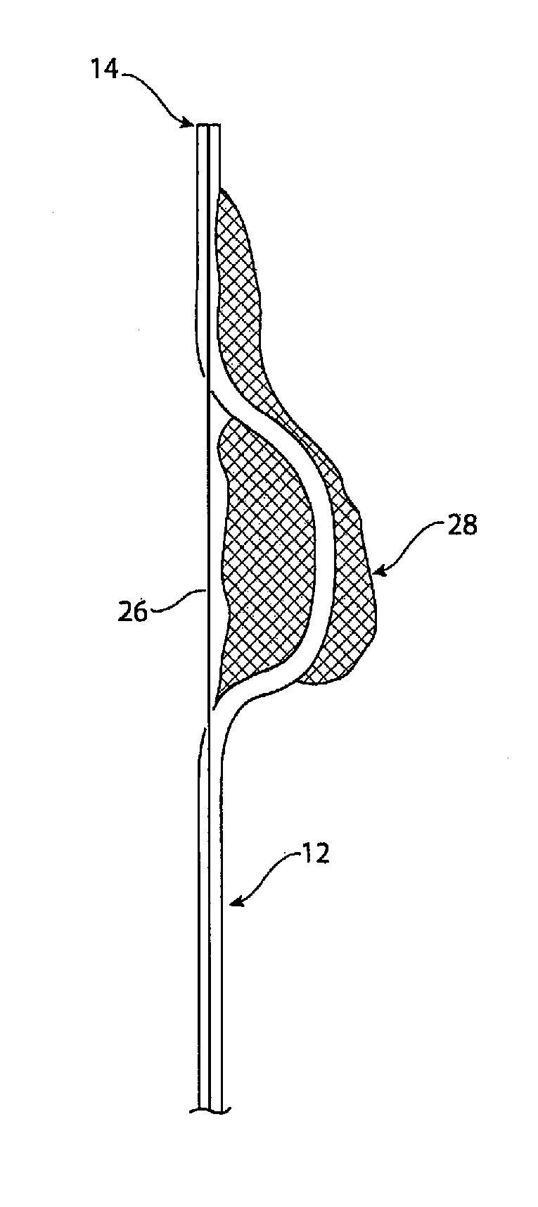 Obstruction capture and removal device