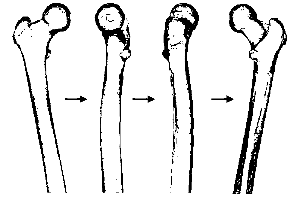 Thighbone biomechanics finite element analysis system based on force feedback