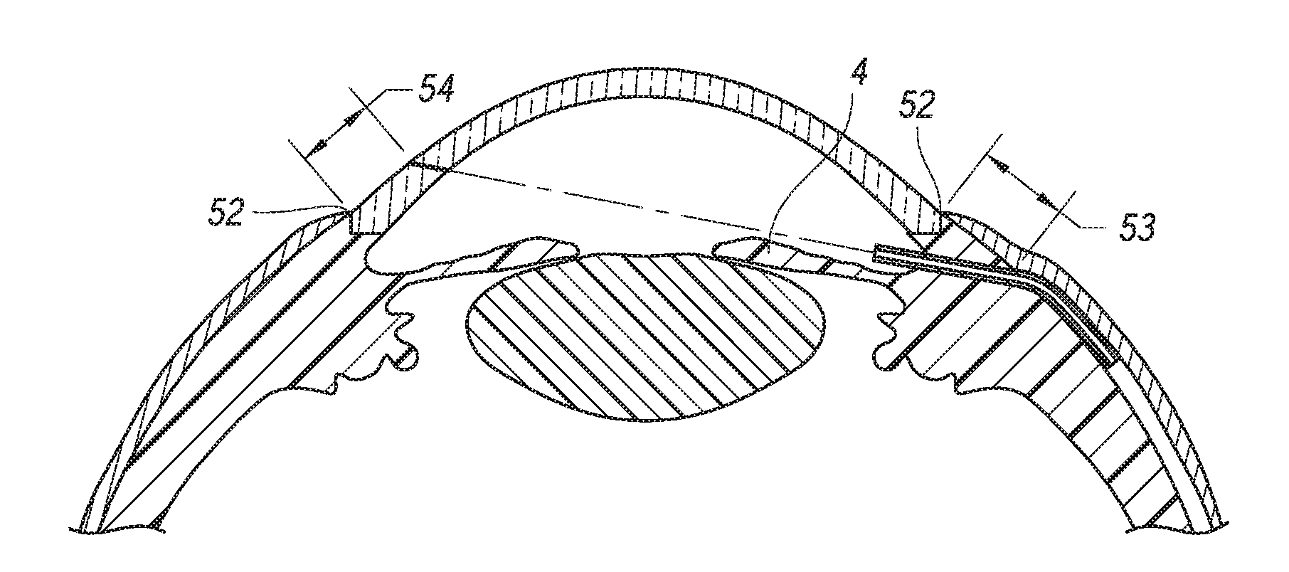 Methods for implanting intraocular shunts