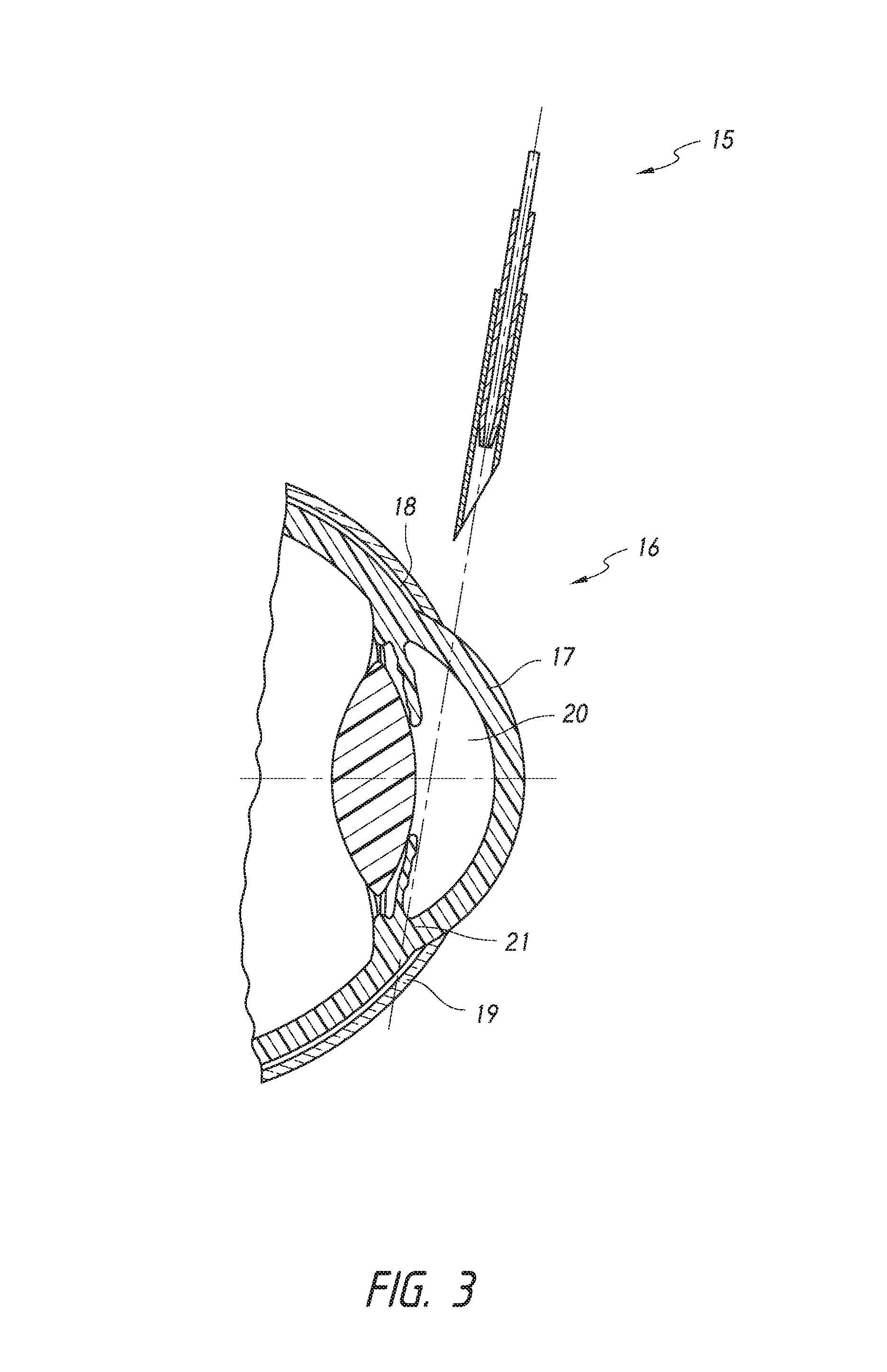 Methods for implanting intraocular shunts