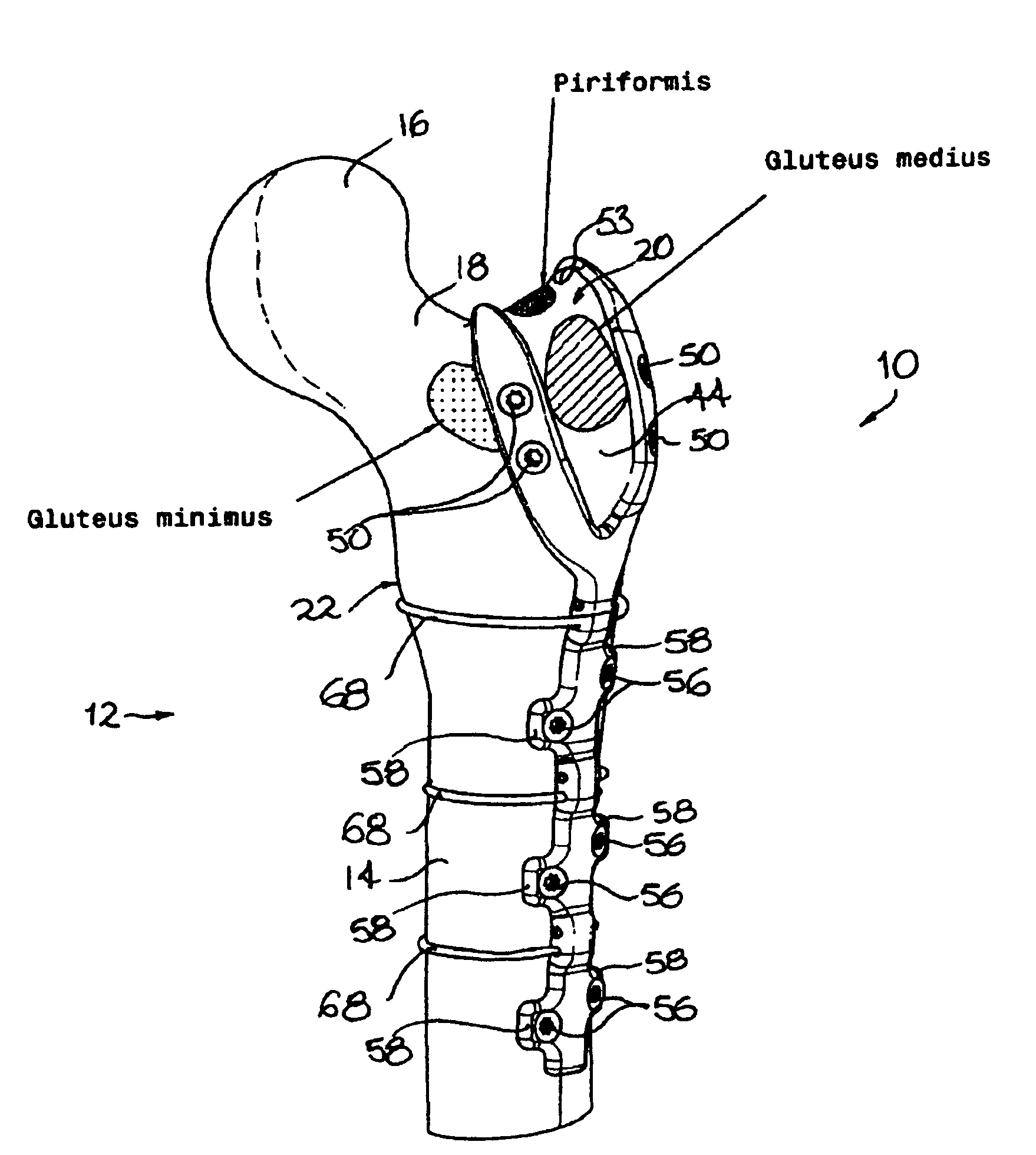 Orthopaedic fixation component and method