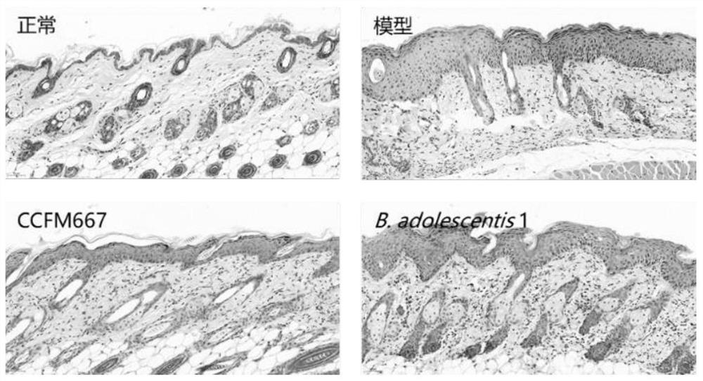 Bifidobacterium adolescentis capable of relieving psoriasis and application thereof