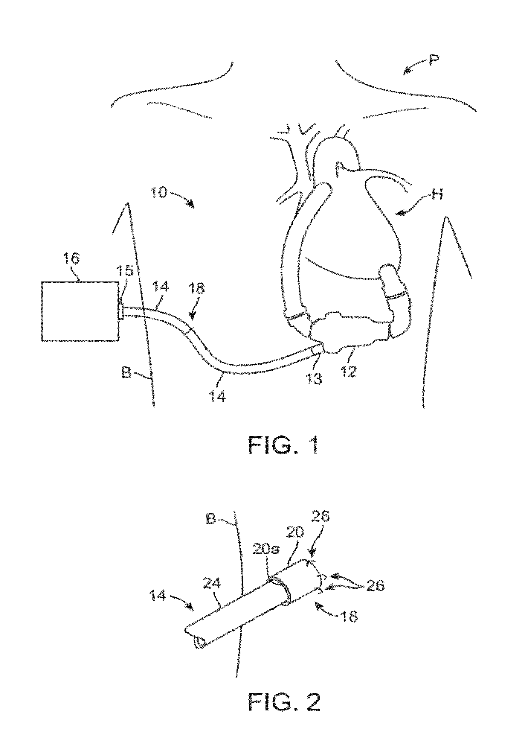 Assembly and method for stabilizing a percutaneous cable