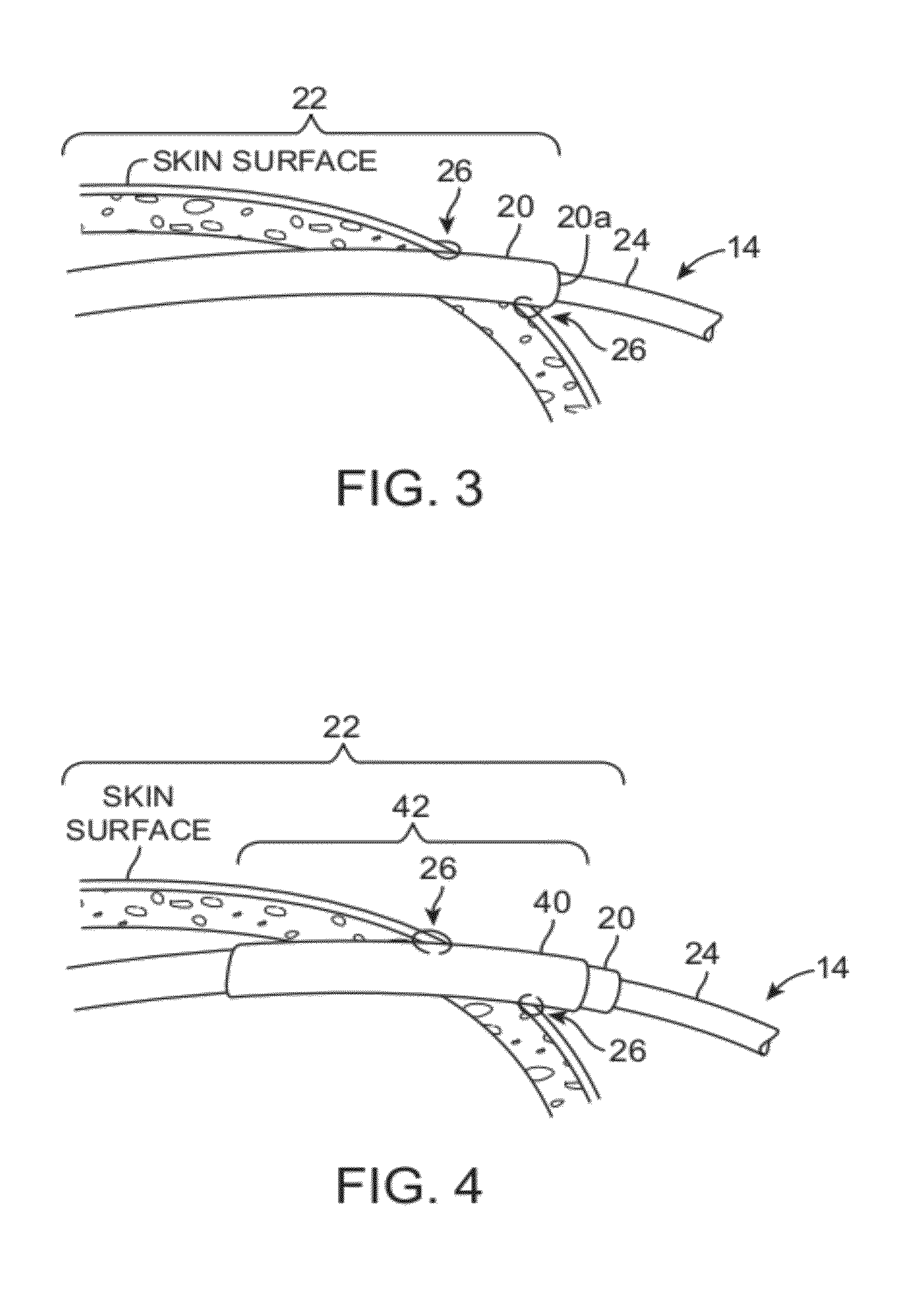 Assembly and method for stabilizing a percutaneous cable