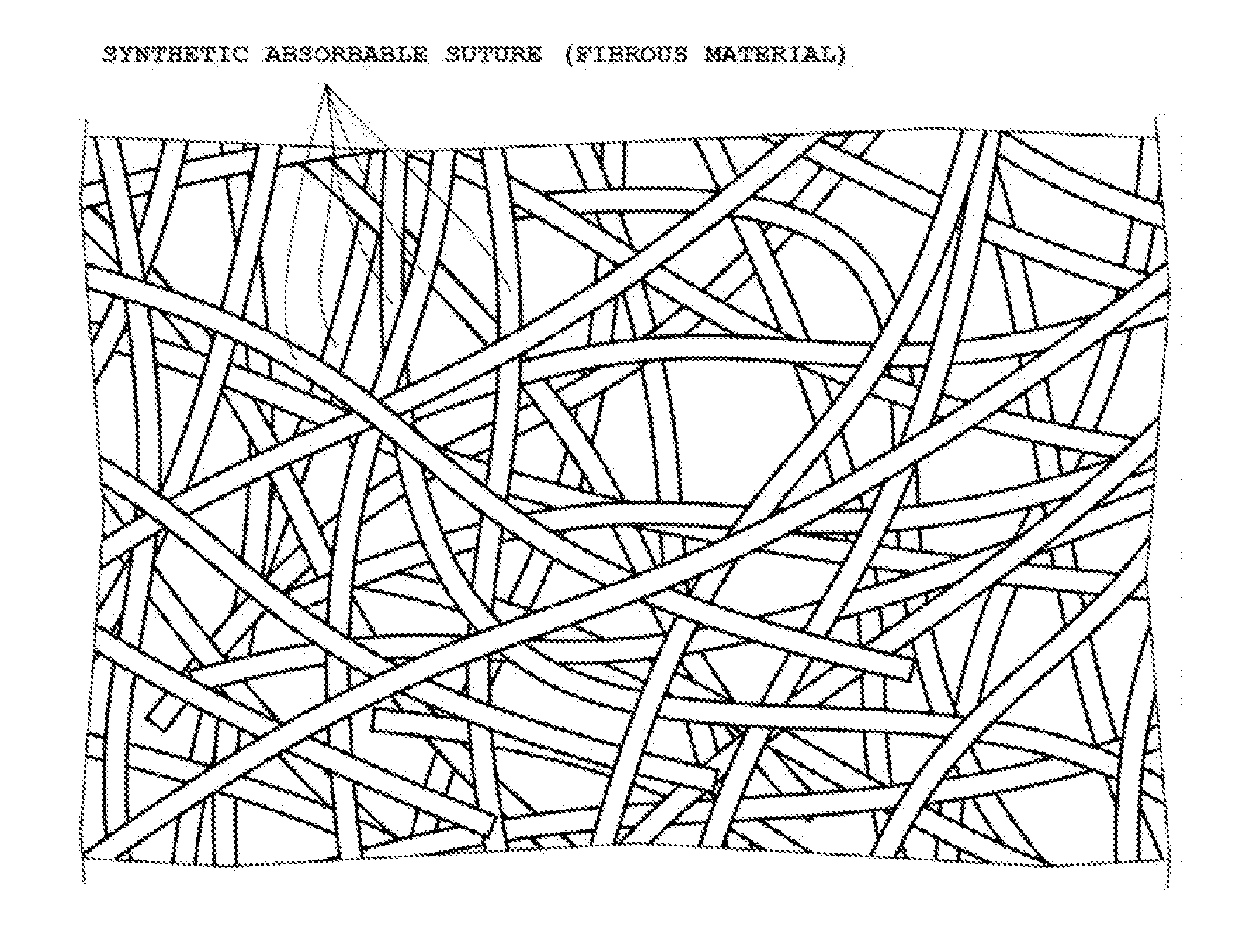 Spacer For Ionized Radiation Therapy