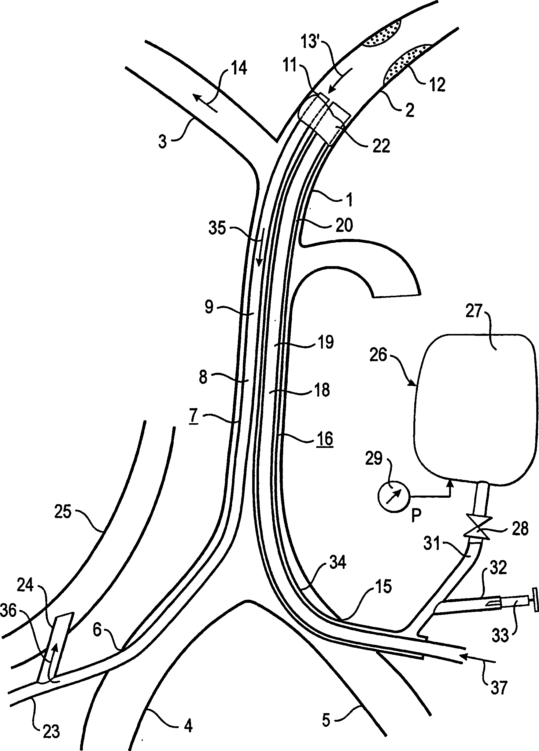 Device and method for reducing or removing stenoses