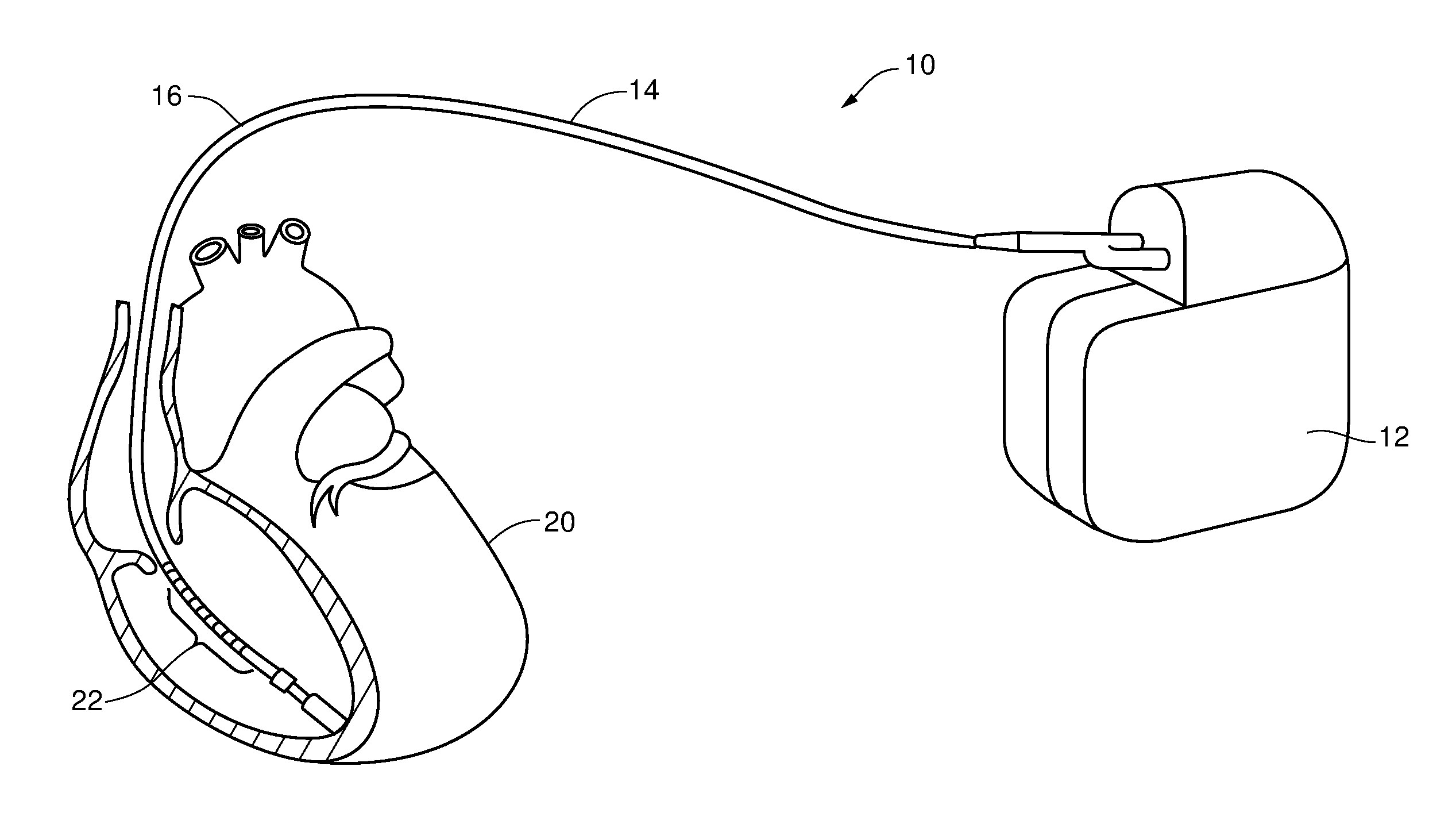 Method and Apparatus for Implantable Cardiac Lead Integrity Analysis