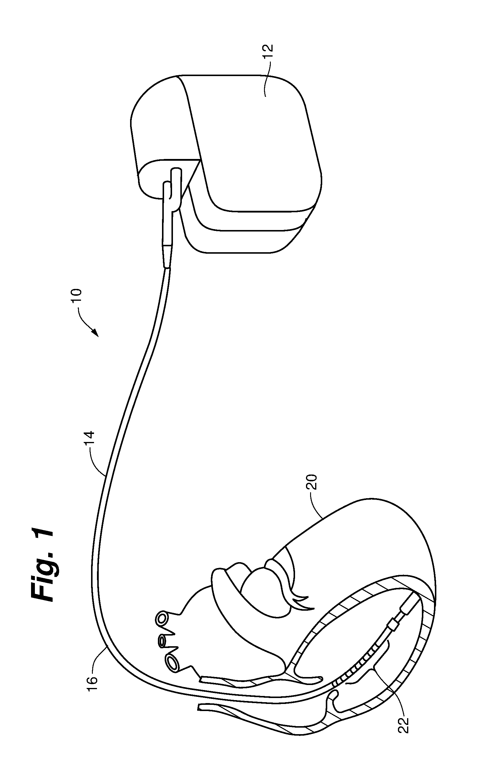 Method and Apparatus for Implantable Cardiac Lead Integrity Analysis