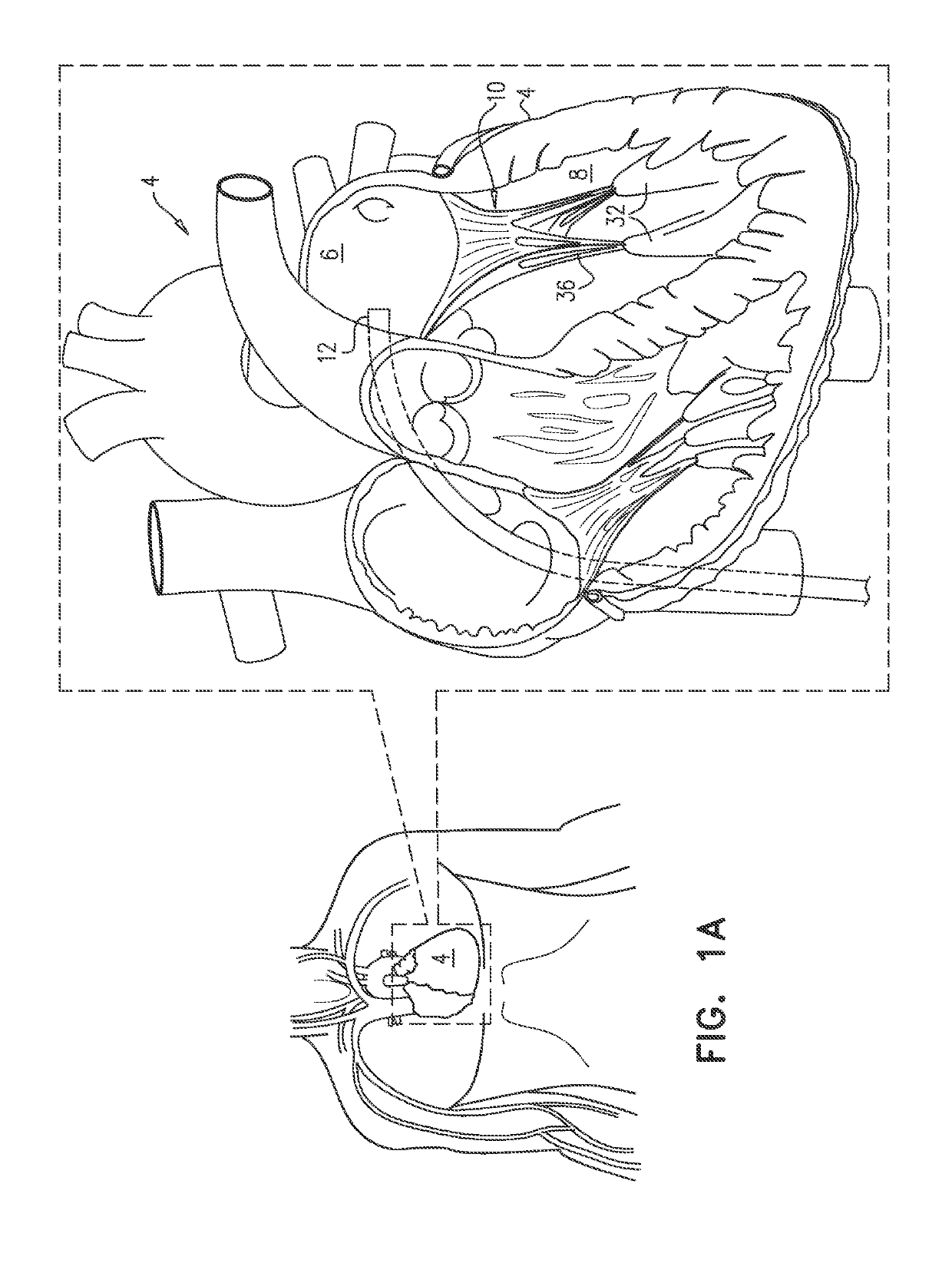 Cinching of dilated heart muscle