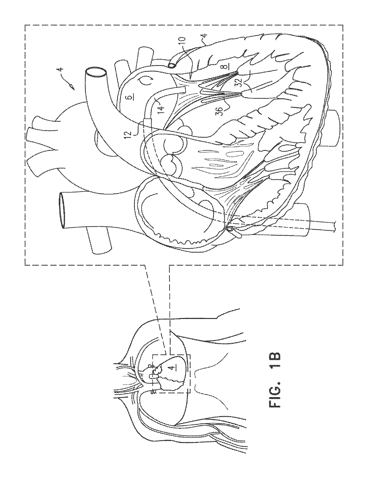 Cinching of dilated heart muscle