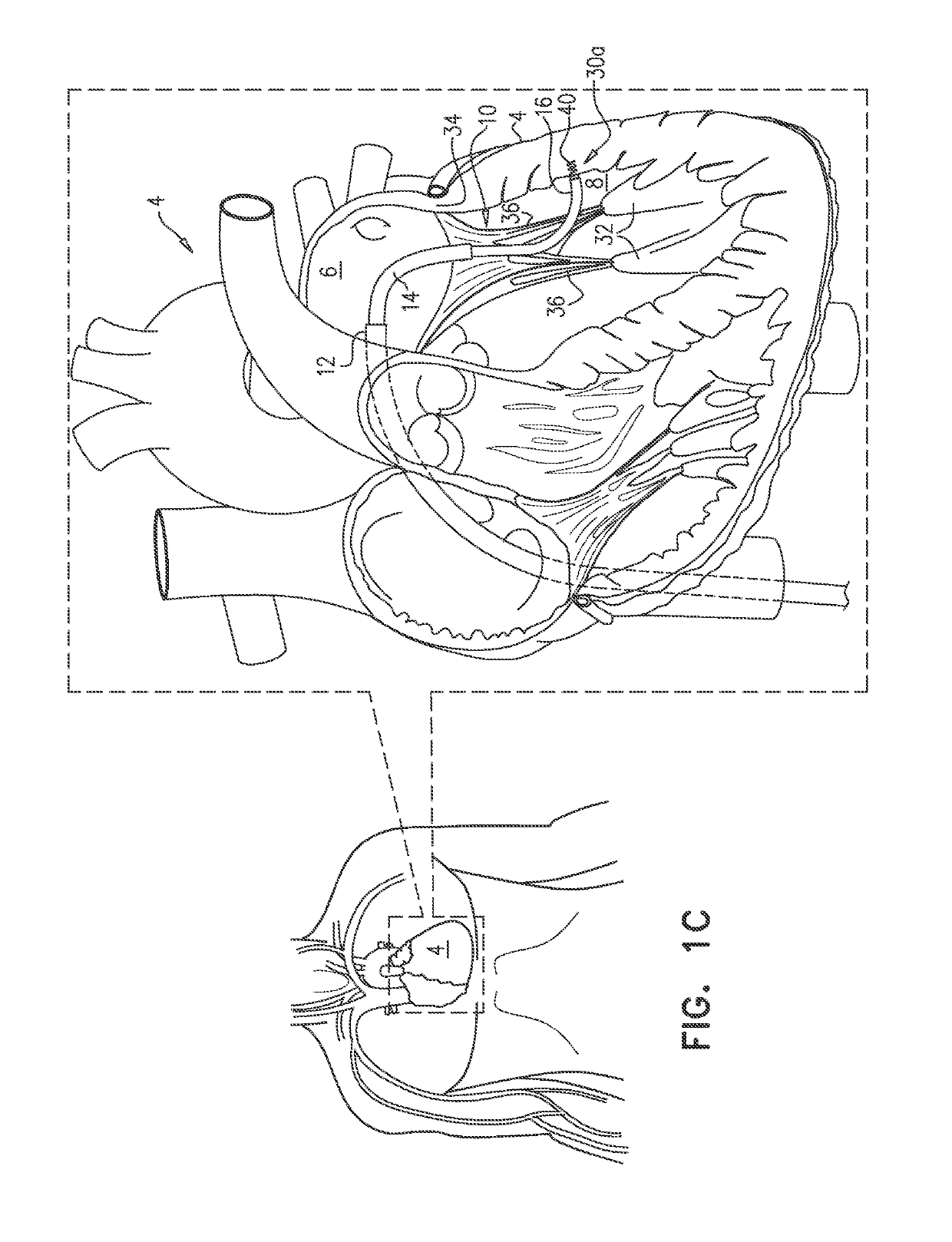 Cinching of dilated heart muscle