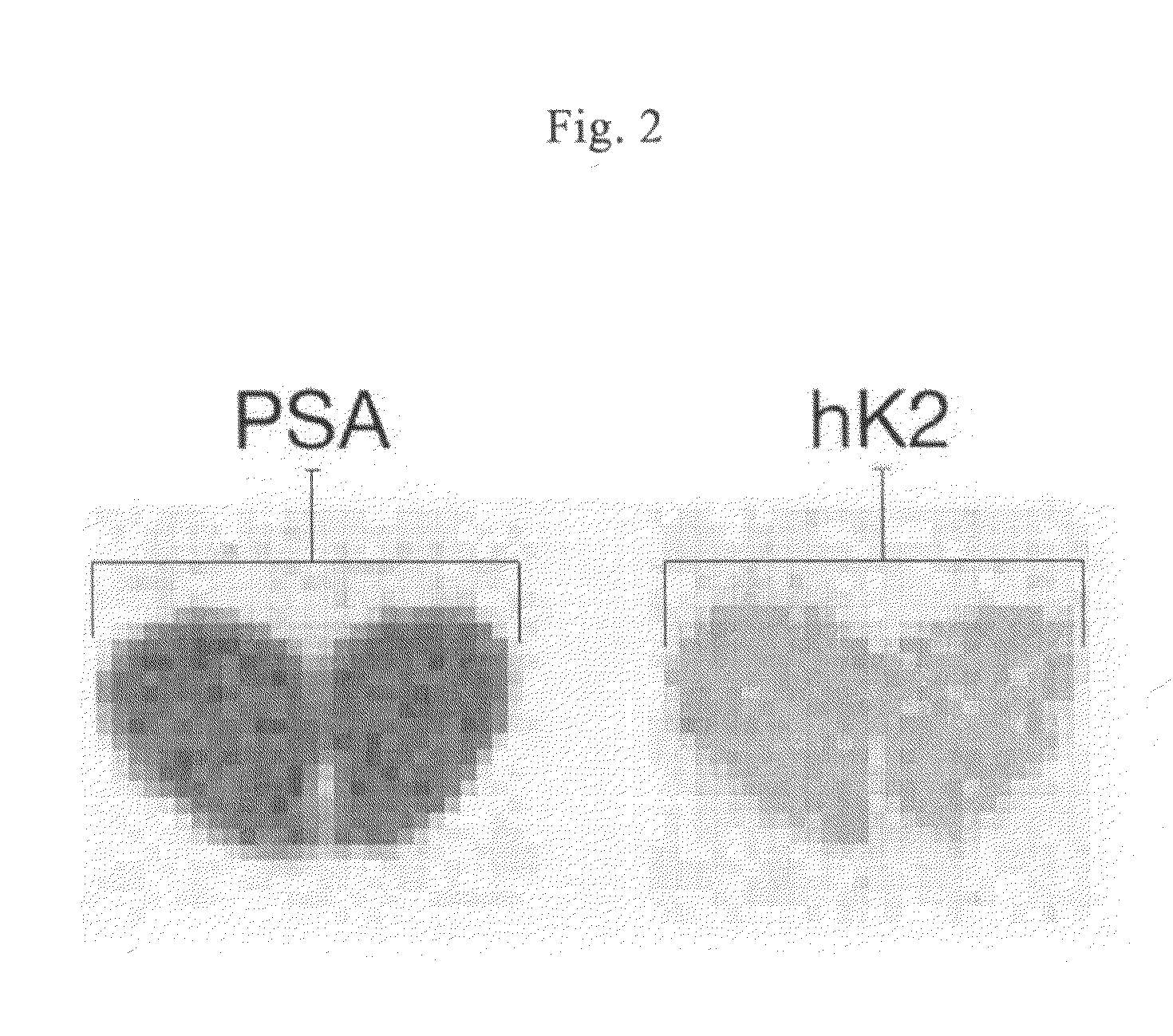 Diagnosis of Prostate Cancer