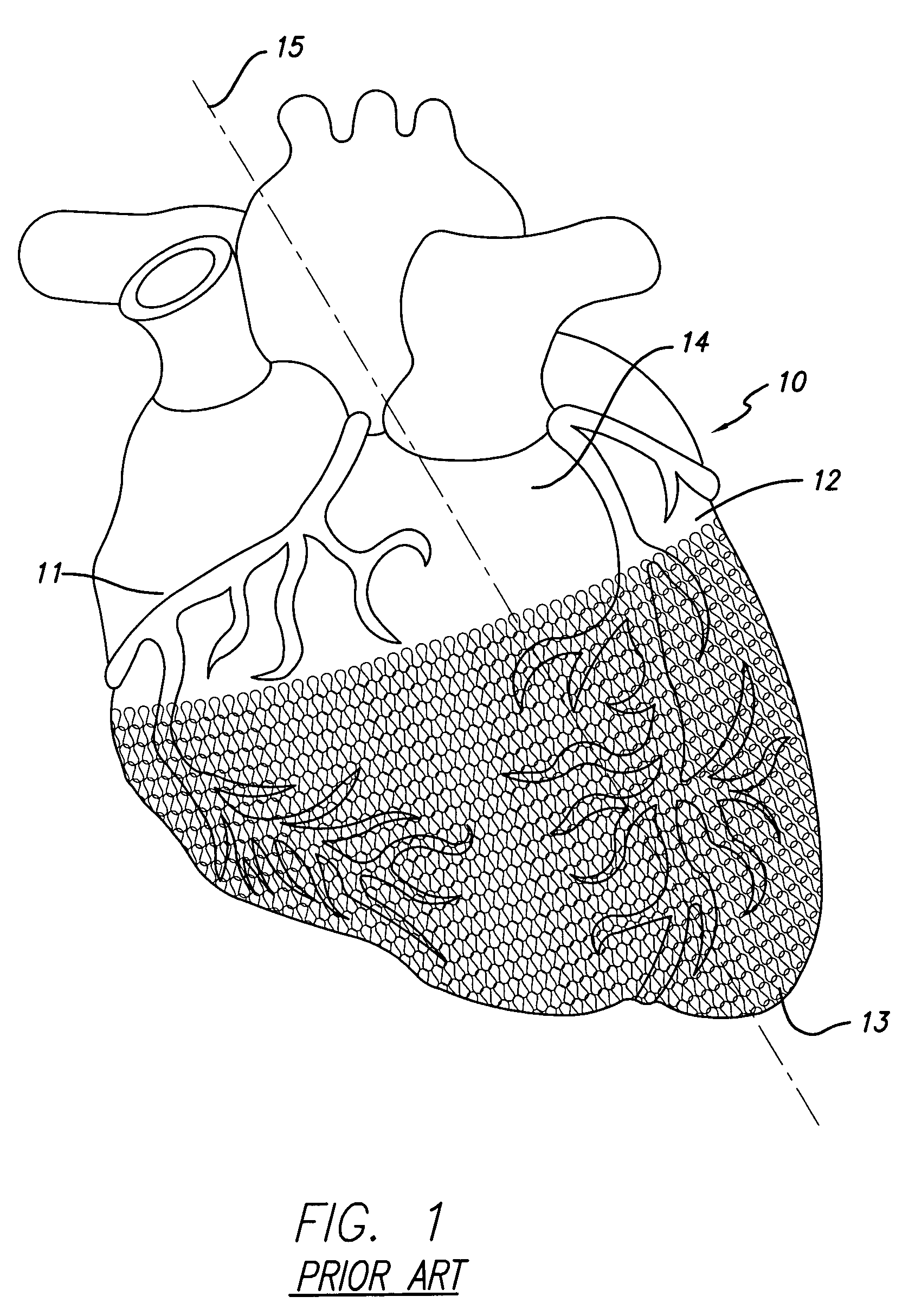 Cardiac harness for treating congestive heart failure and for defibrillating and/or pacing/sensing