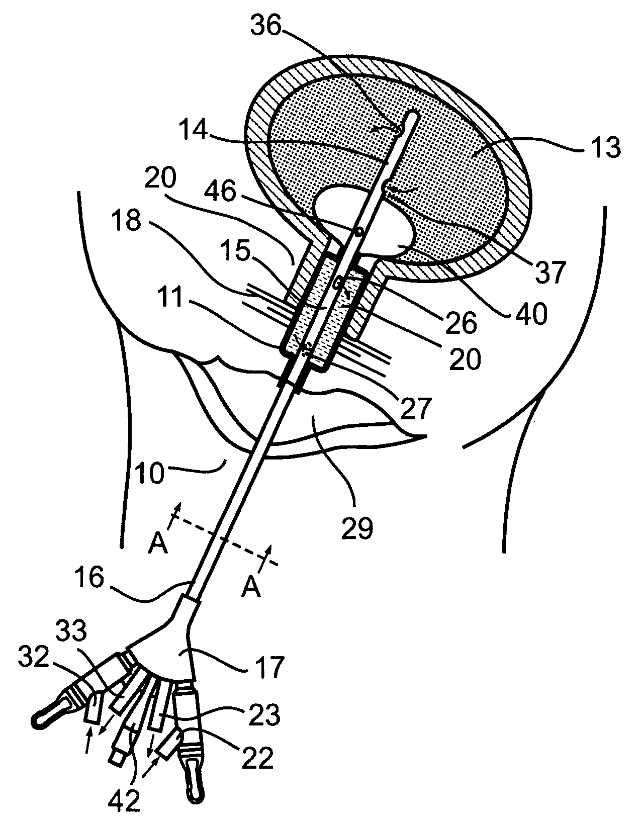 System and method for treating urinary tract disorders