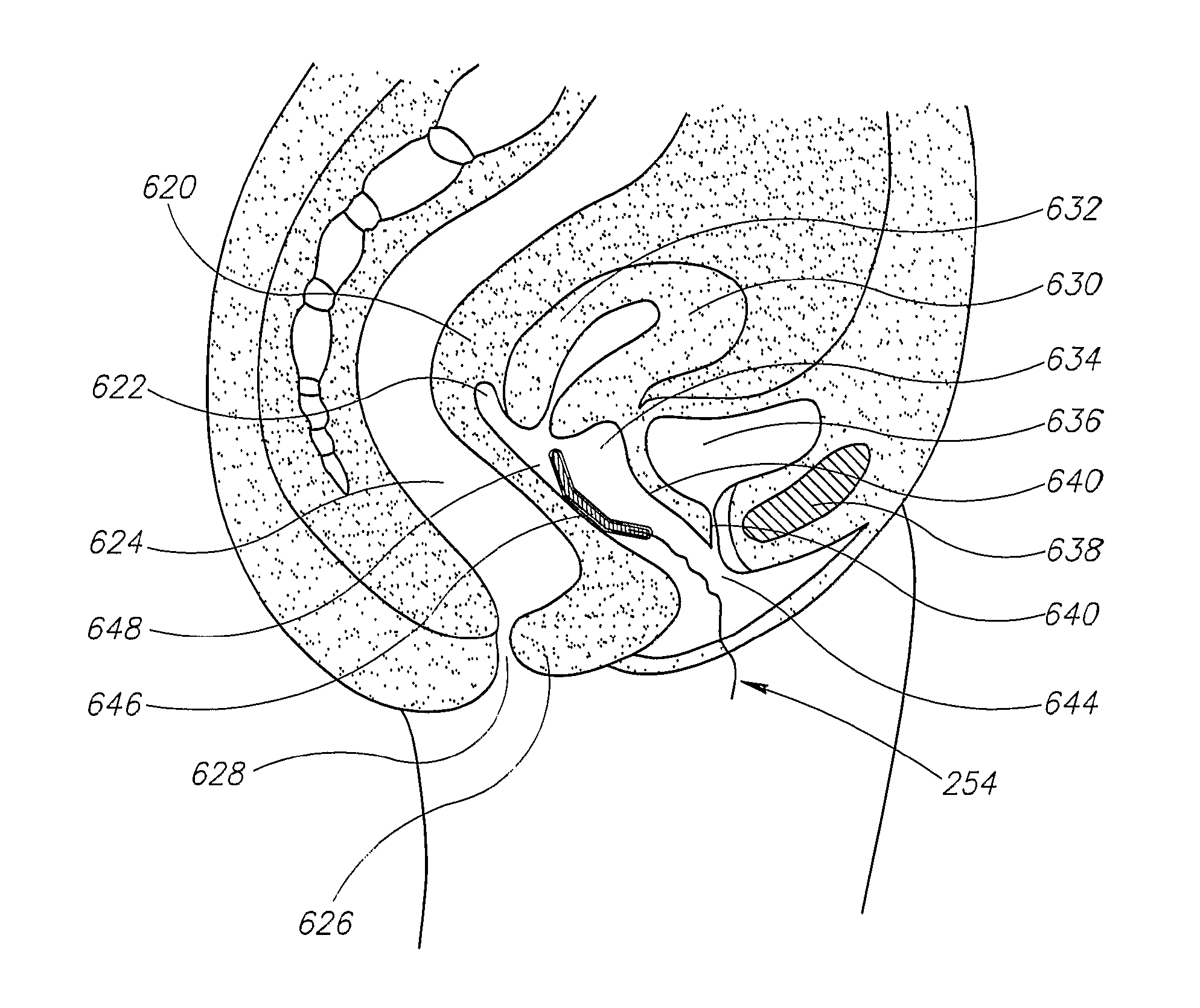 Apparatus for the treatment of feminine pelvic organ prolapse