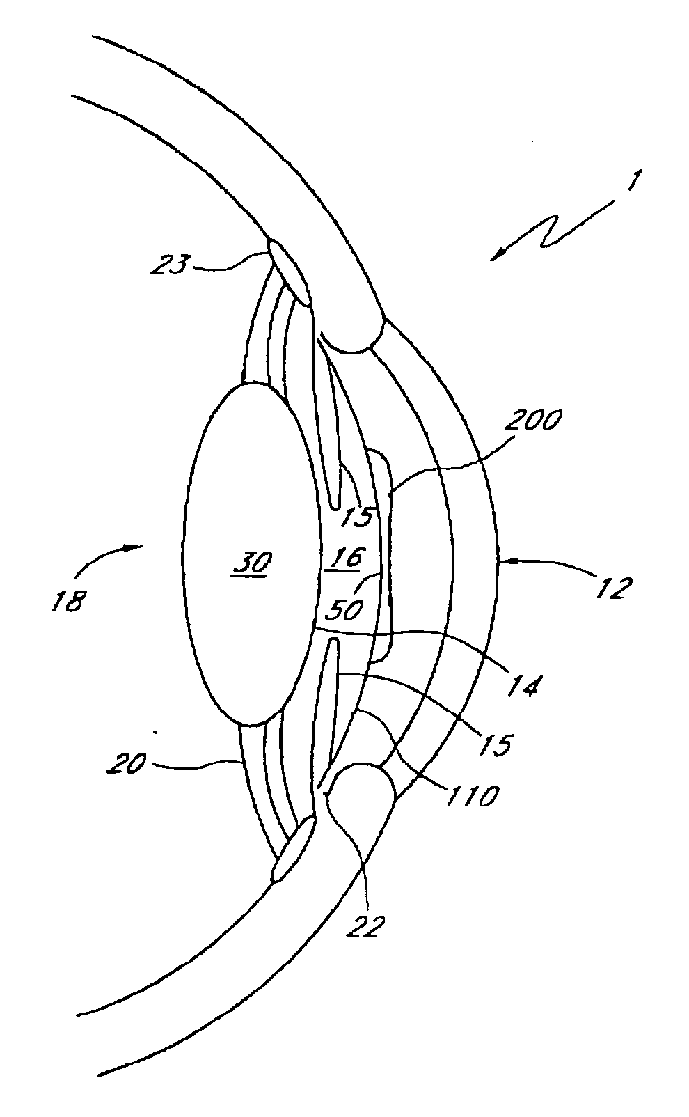 Two part "L" -shaped Phakic IOL