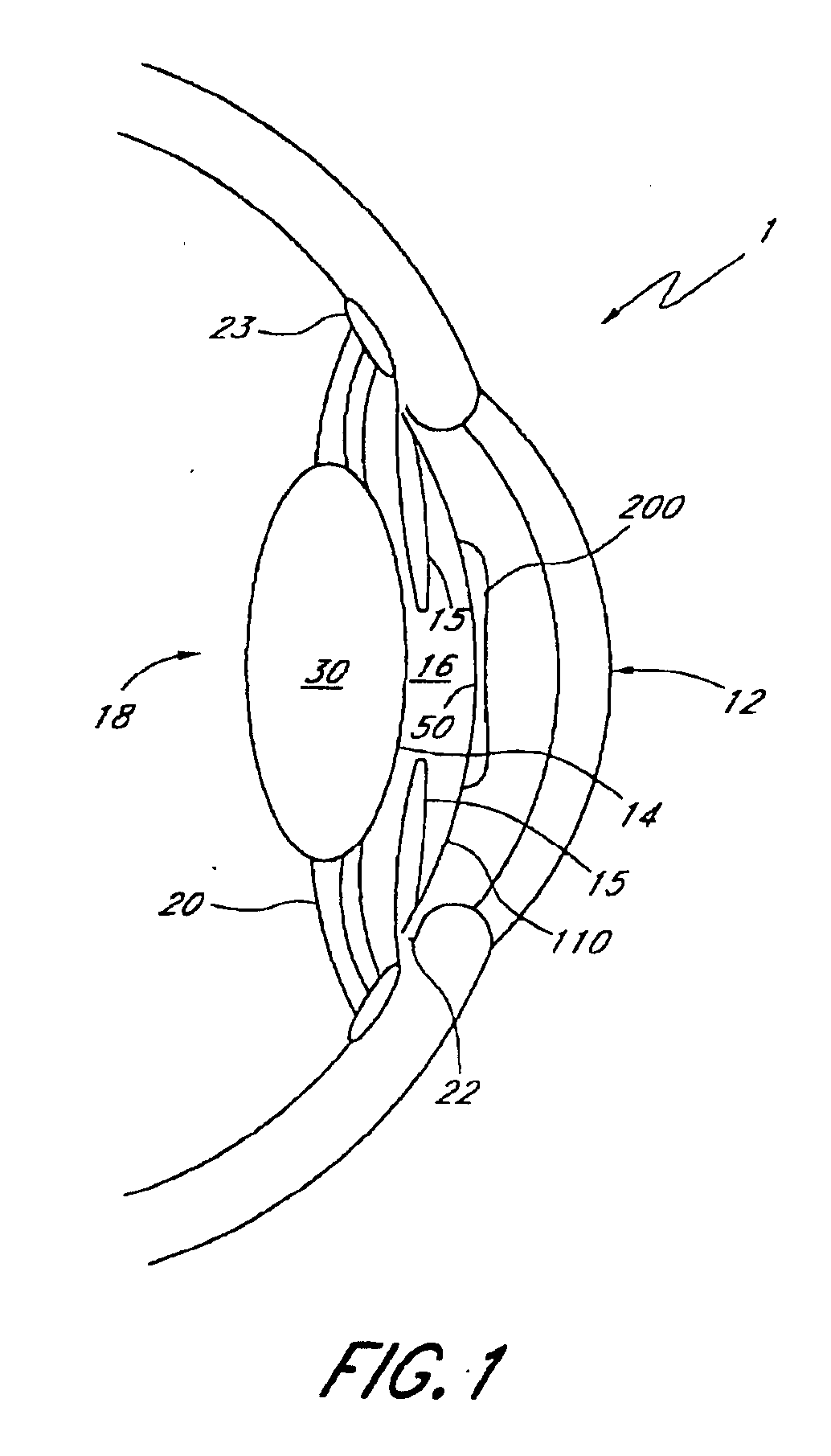 Two part "L" -shaped Phakic IOL