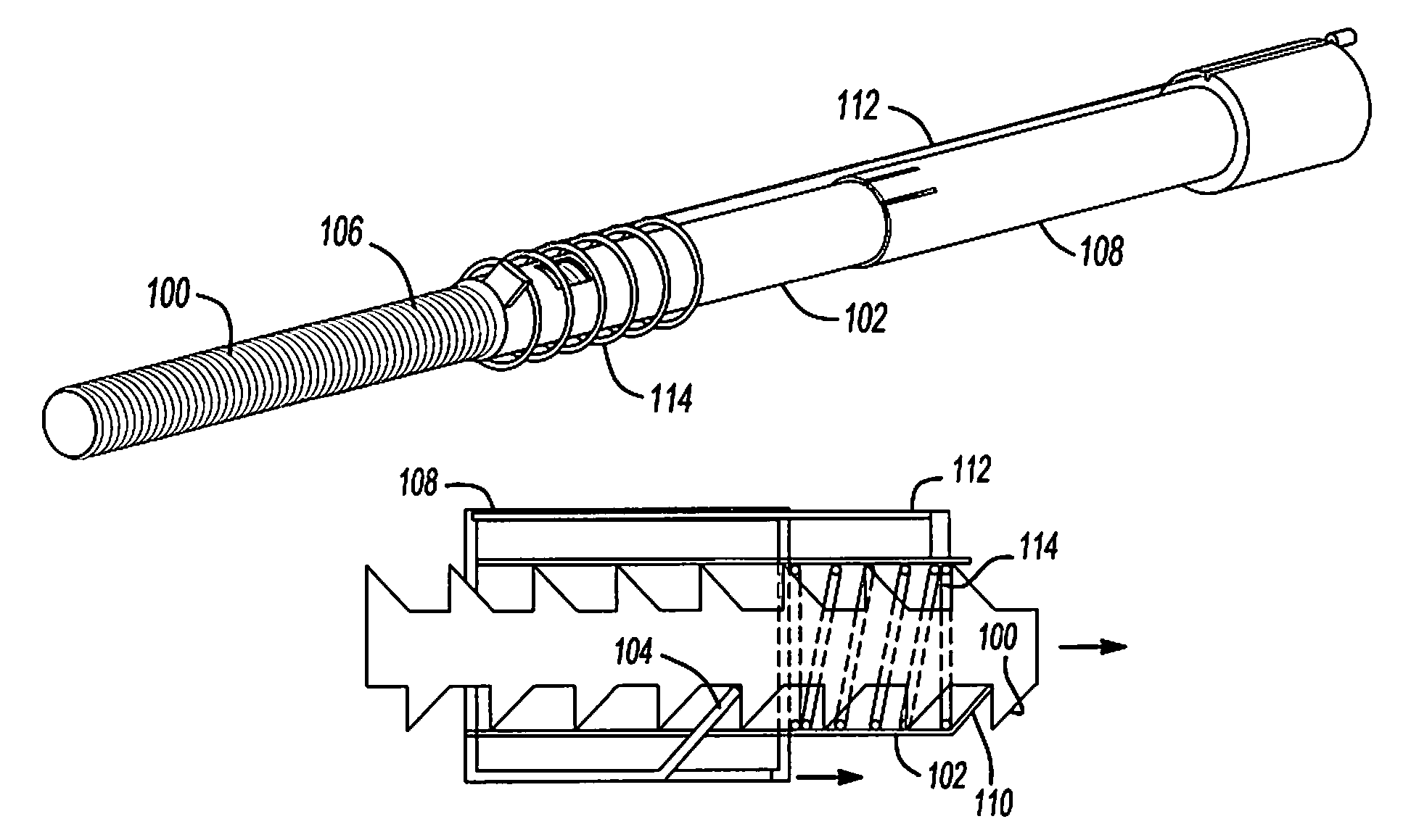 Mechanical extension implants for short bowel syndrome