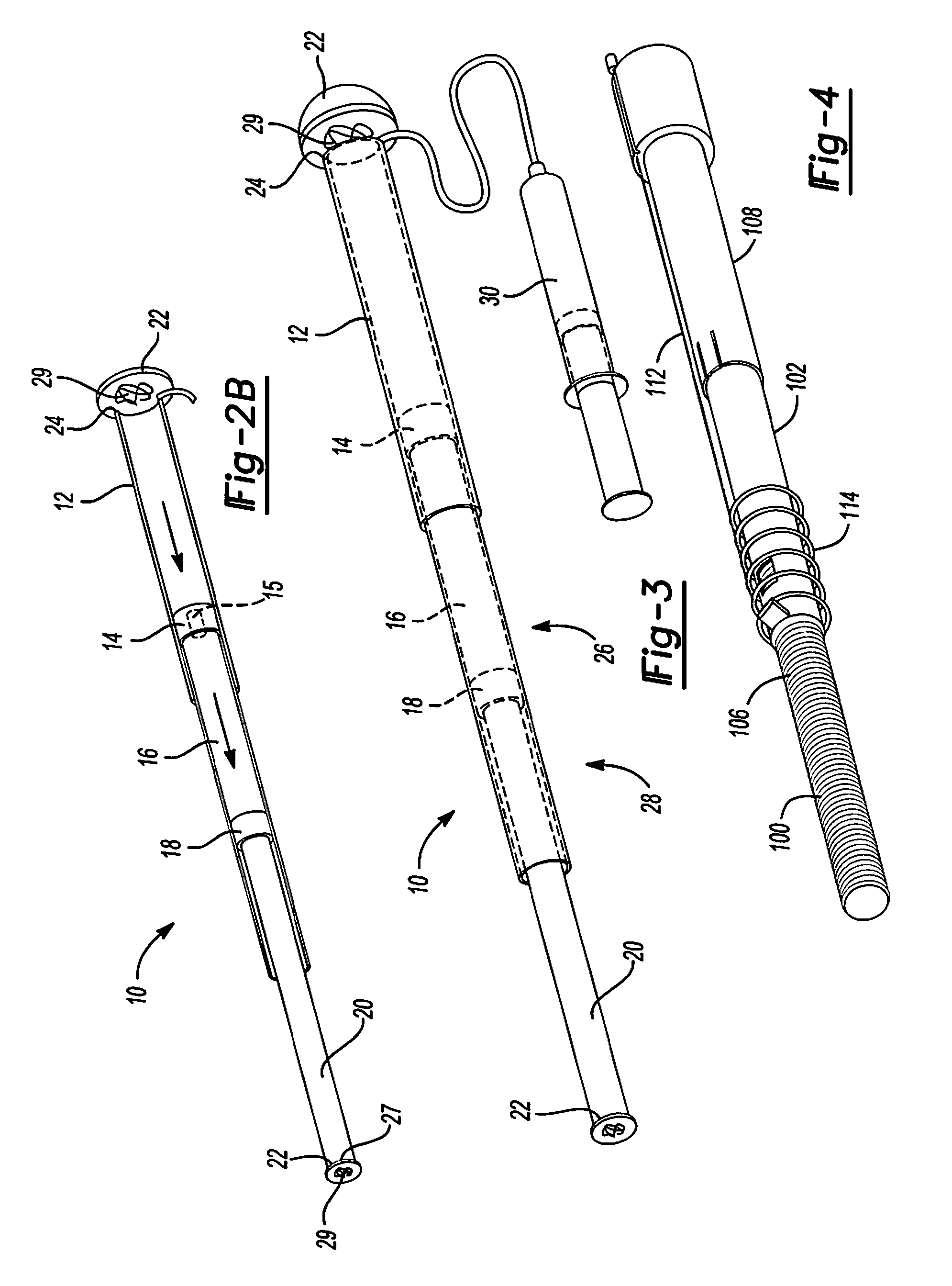 Mechanical extension implants for short bowel syndrome