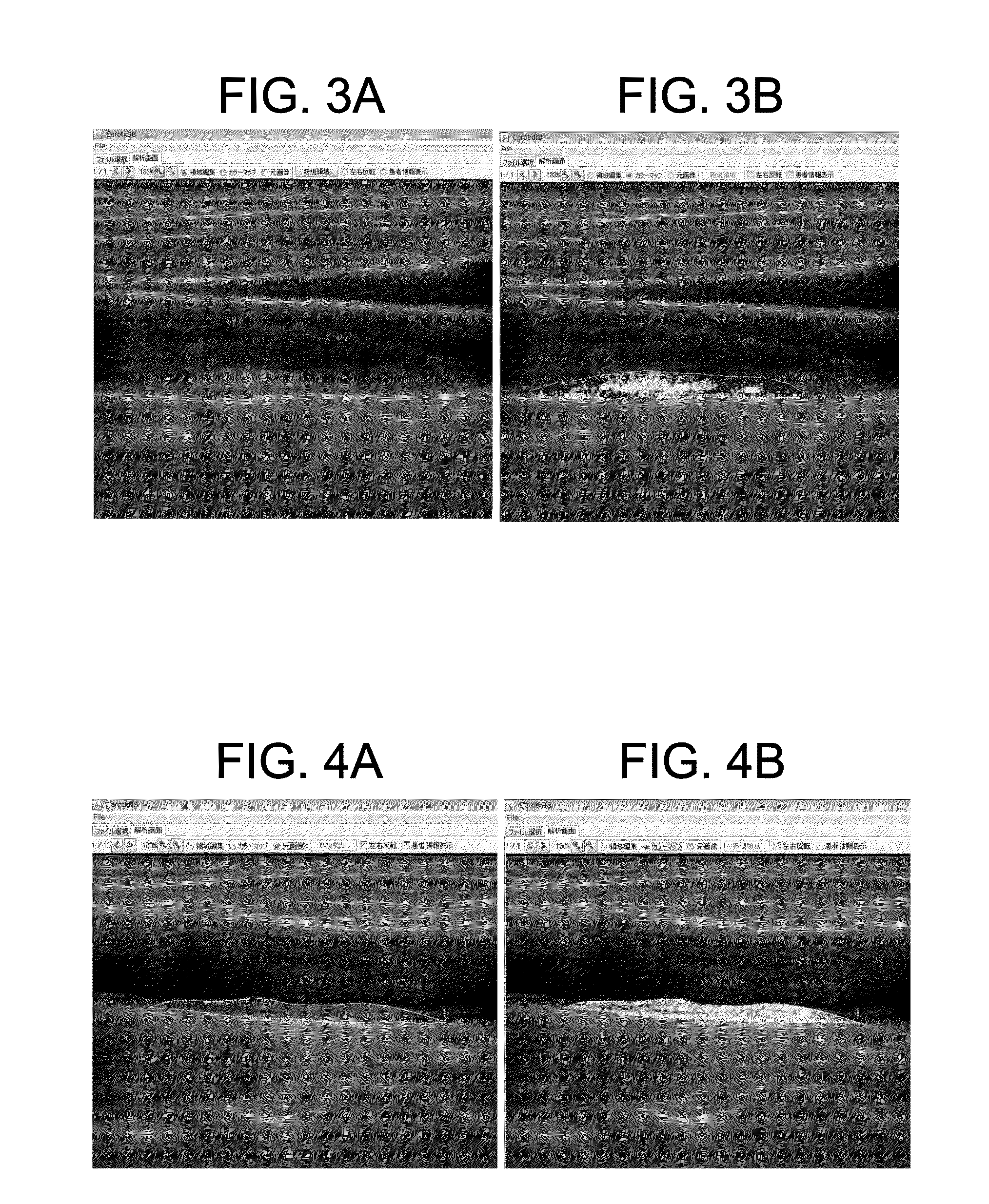 Carotid-artery-plaque ultrasound-imaging method and evaluating device